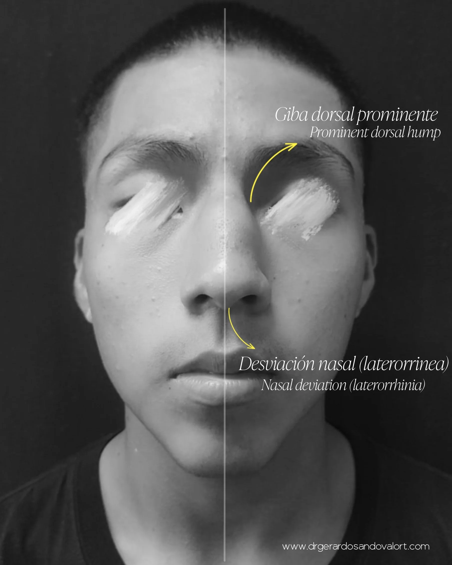 rinoplastia-caso1-masculino-antes-lima-dr-luis-gerardo-sandoval.jpg