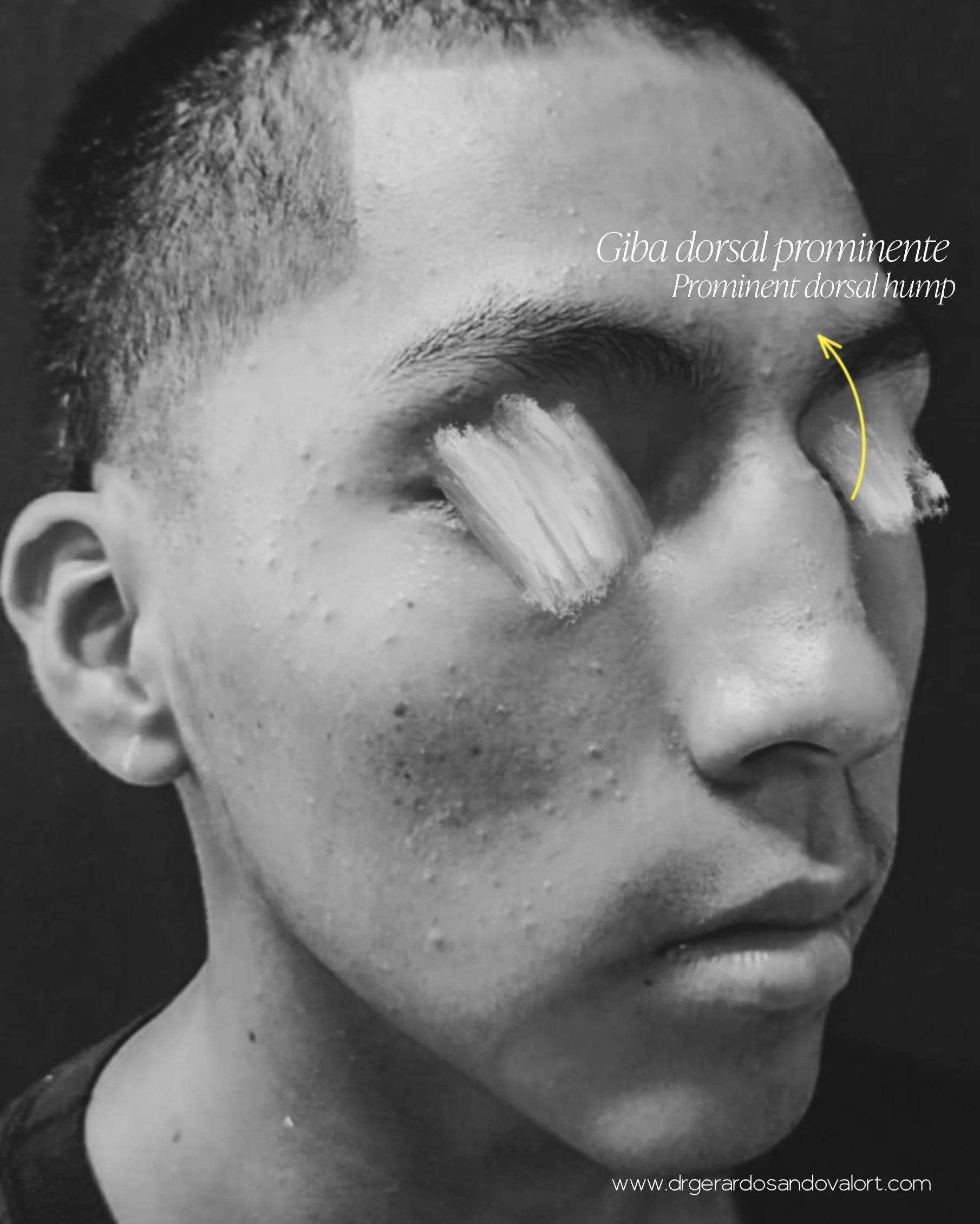 rinoplastia-caso1-masculino-antes-lima-dr-luis-gerardo-sandoval-derecho.jpg