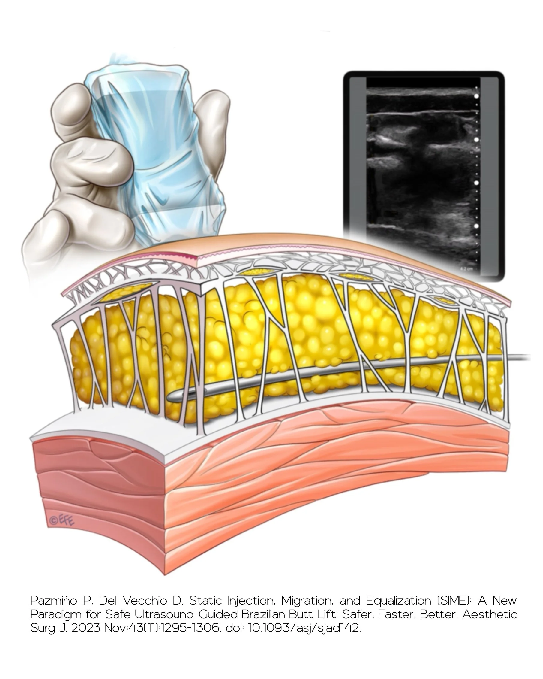 Ecografía Intraoperatoria en Lipoinjerto Glúteo