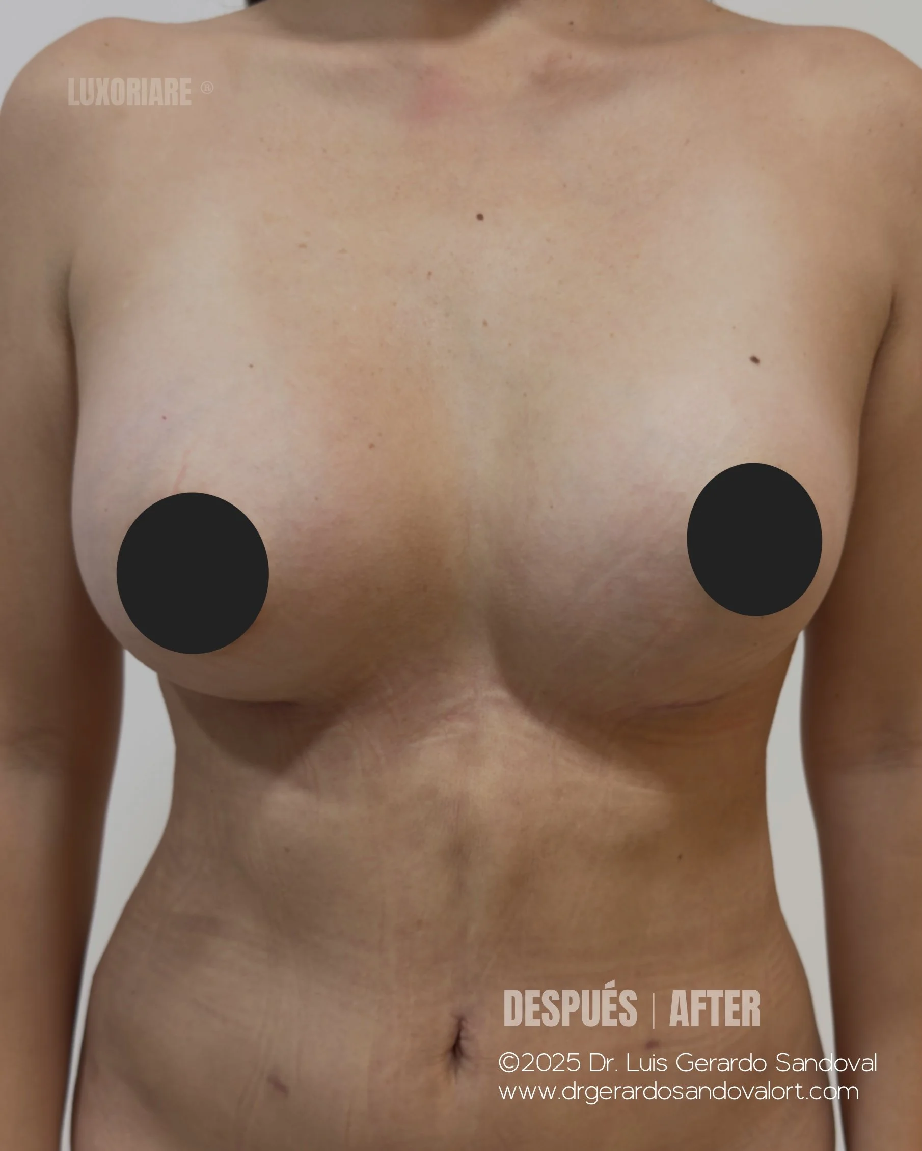 Caso 4 – Corrección de Mama Tuberosa con Implantes Motiva® 295cc (Frontal)