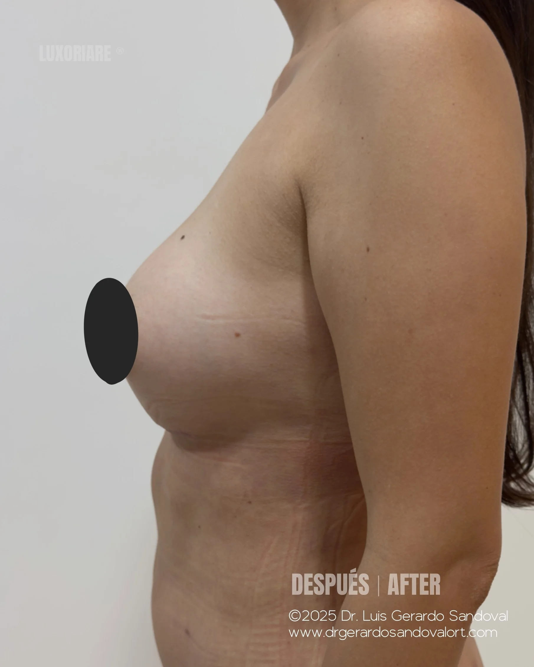 Caso 4 – Resultado de Aumento Mamario Subfascial con Motiva® 295cc (Lateral Derecha)