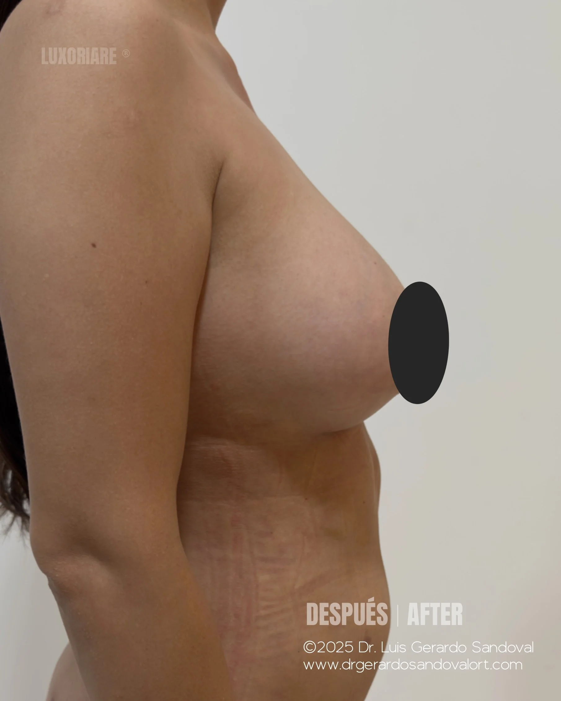 Caso 4 – Aumento Mamario con Implantes Motiva® 295cc (Lateral Izquierda)