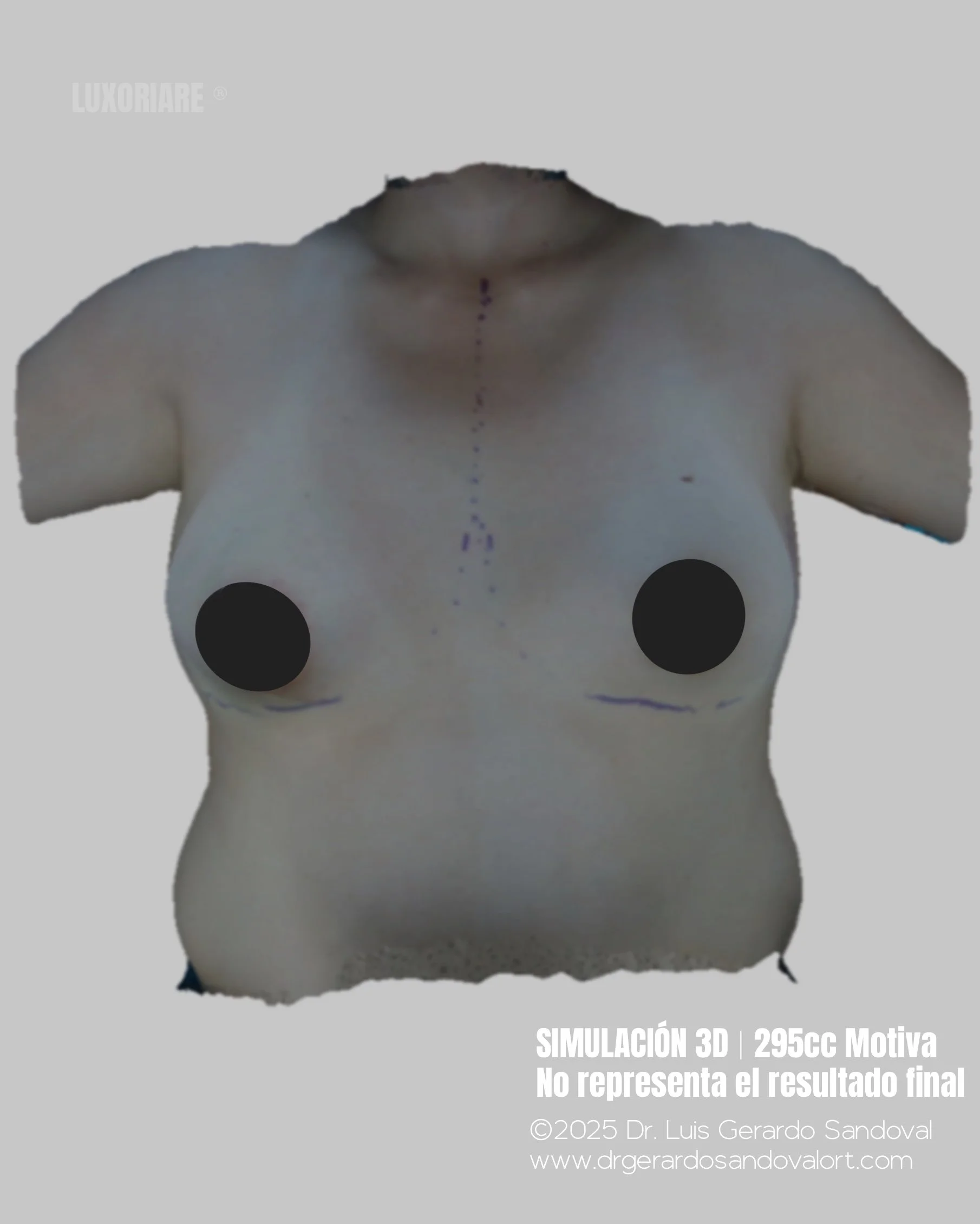 Simulación 3D frontal de aumento mamario con implantes Motiva® 295cc