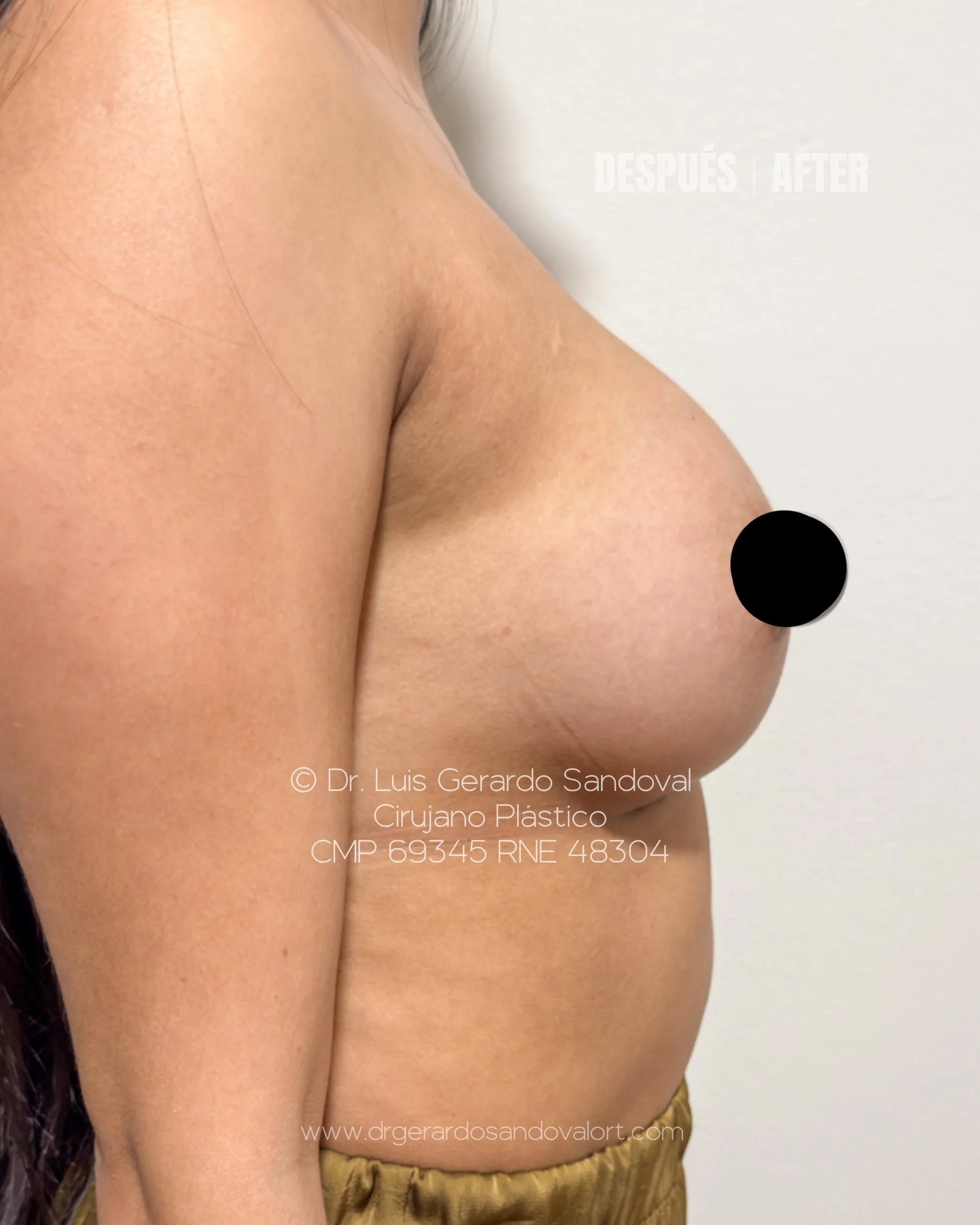 caso-5-despues-aumento-mamario-implantes-motiva-lateral-izquierda-lima-dr-luis-gerardo-sandoval.jpg