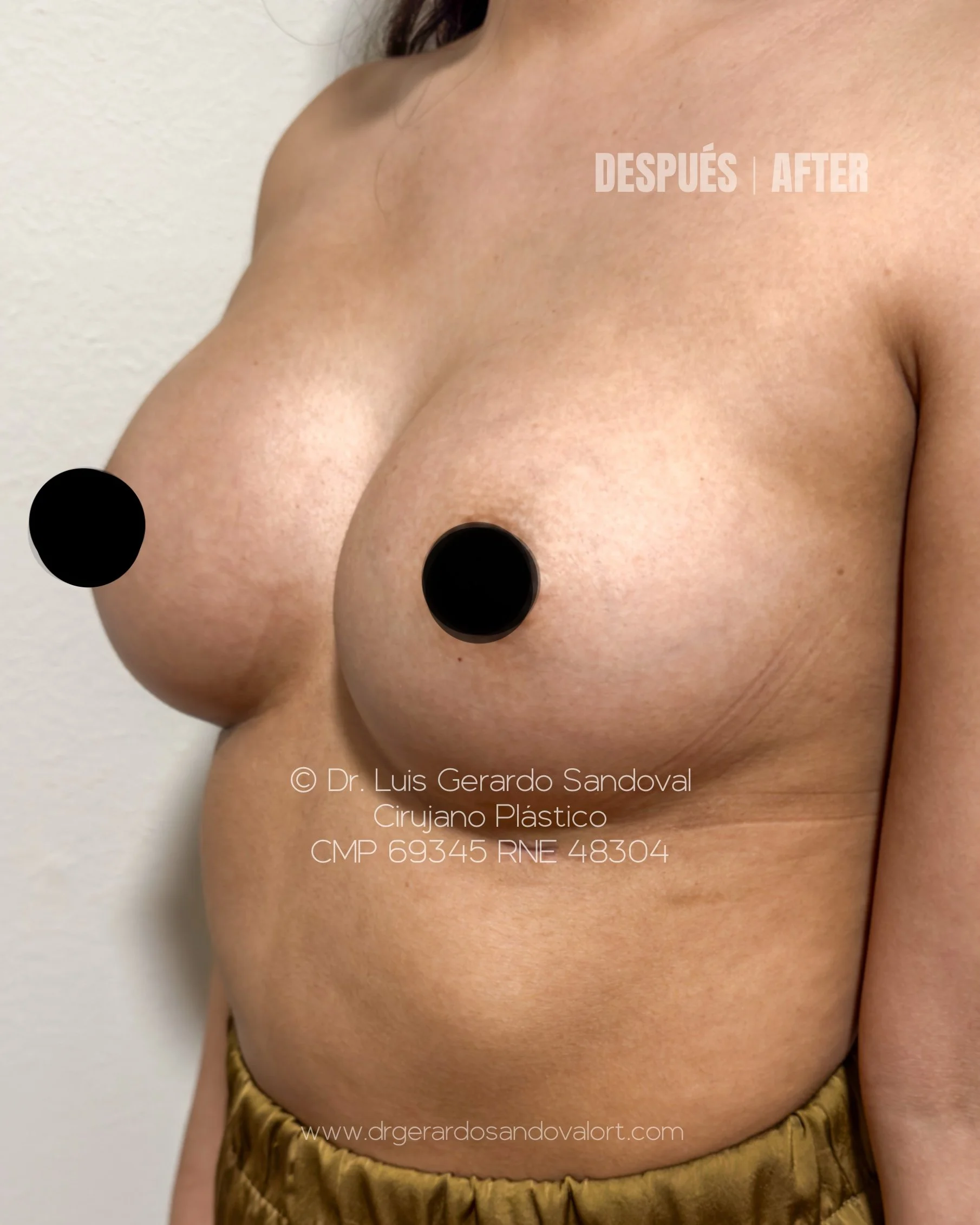 caso-5-despues-aumento-mamario-implantes-motiva-45-grados-derecha-lima-dr-luis-gerardo-sandoval.jpg