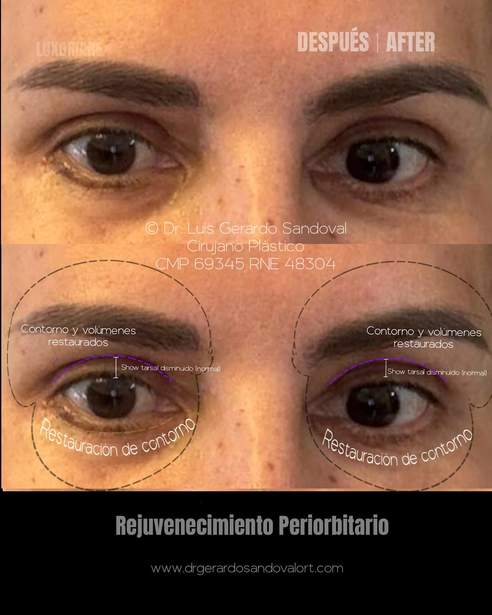 Resultado del Rejuvenecimiento Periorbitario – Caso Real