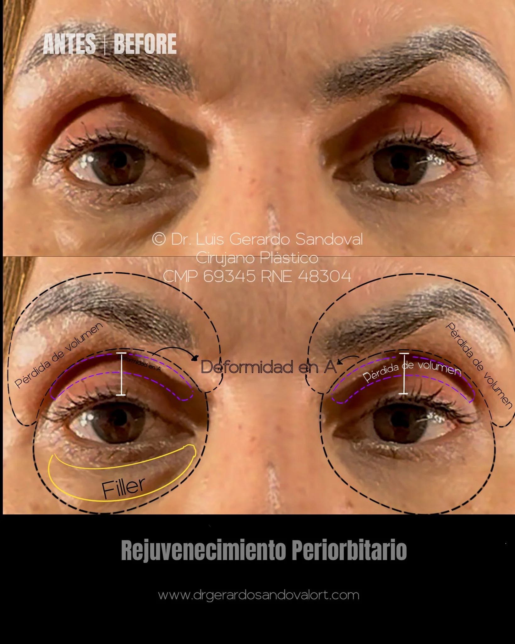 Evaluación Preoperatoria del Rejuvenecimiento Periorbitario – Caso Real