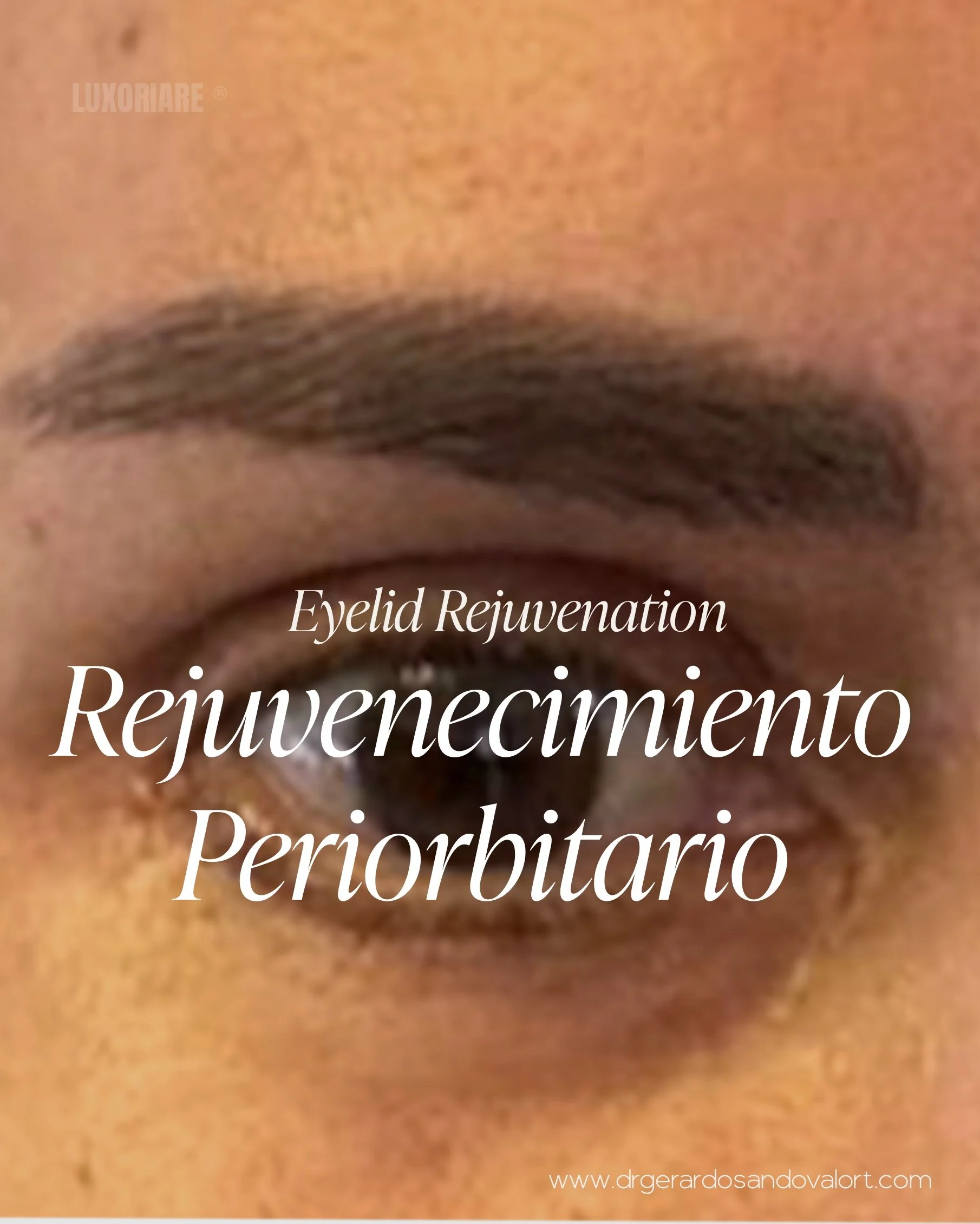 Rejuvenecimiento Periorbitario en Lima: Caso Real Antes y Después de Blefaroplastia Transcutánea y Lipofilling 