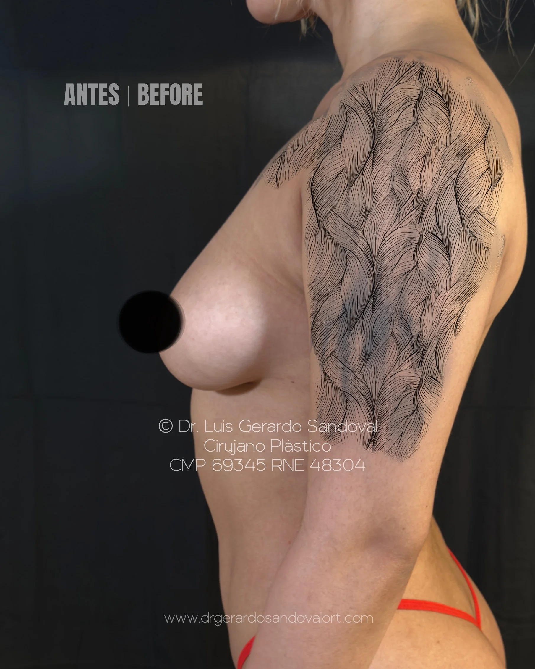caso-06-antes-aumento-mamario-lateral-derecha-lima-dr-luis-gerardo-sandoval.JPG