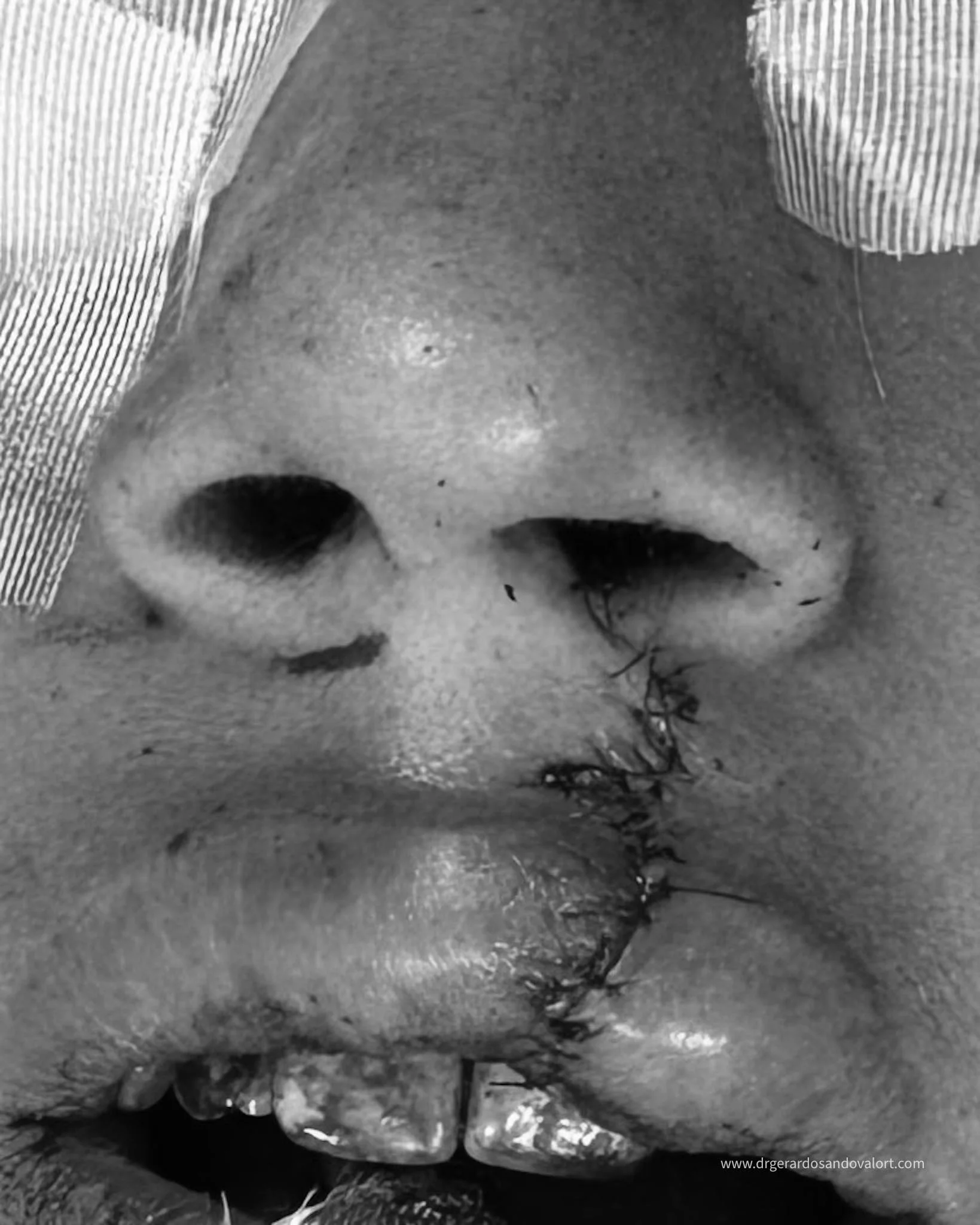 Primer plano del postoperatorio inmediato de un paciente con labio fisurado, tras ser intervenido exitosamente por el Dr. Luis Gerardo Sandoval durante la 78ª campaña de Misión Caritas Felices en el Hospital de Apoyo II-2 Sullana.