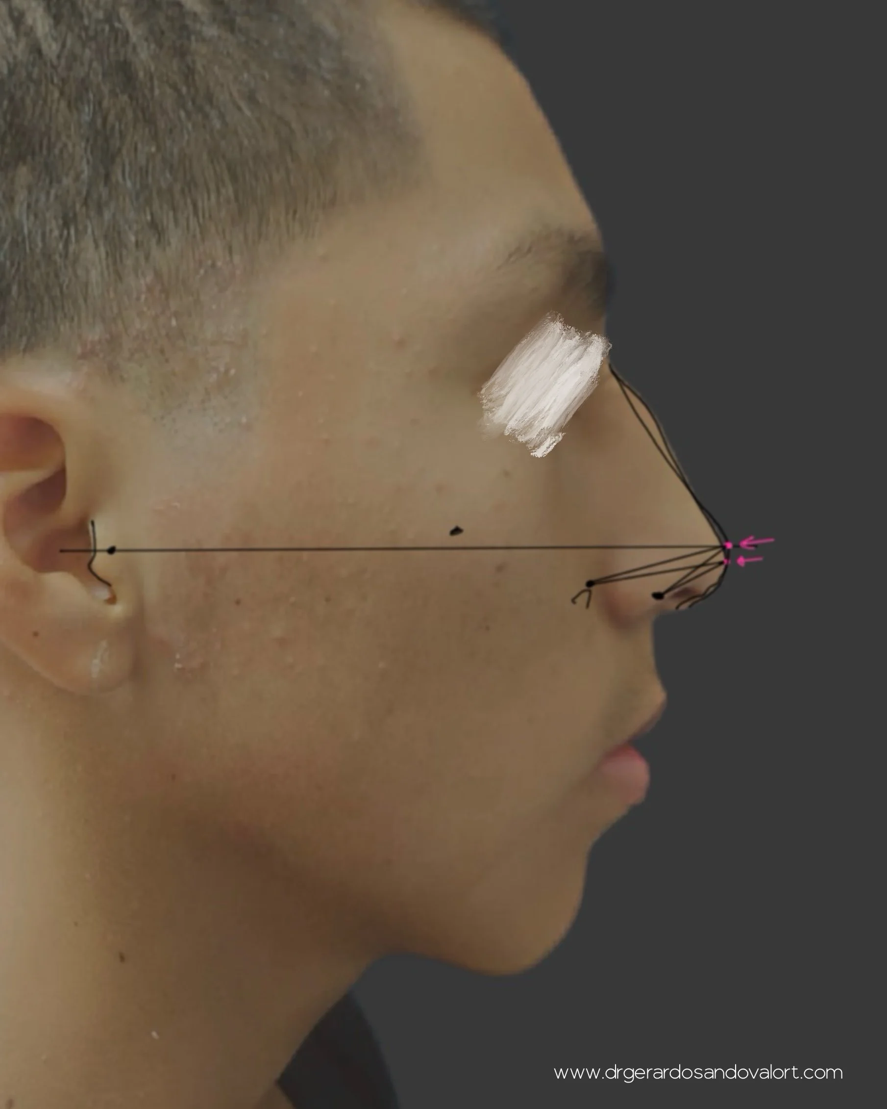 ista lateral del rostro masculino antes de la rinoplastia, destacando la giba dorsal prominente y la leve desviación nasal antes de ser operado por el Dr. Luis Gerardo Sandoval en Lima, especialista en Rinoplastia