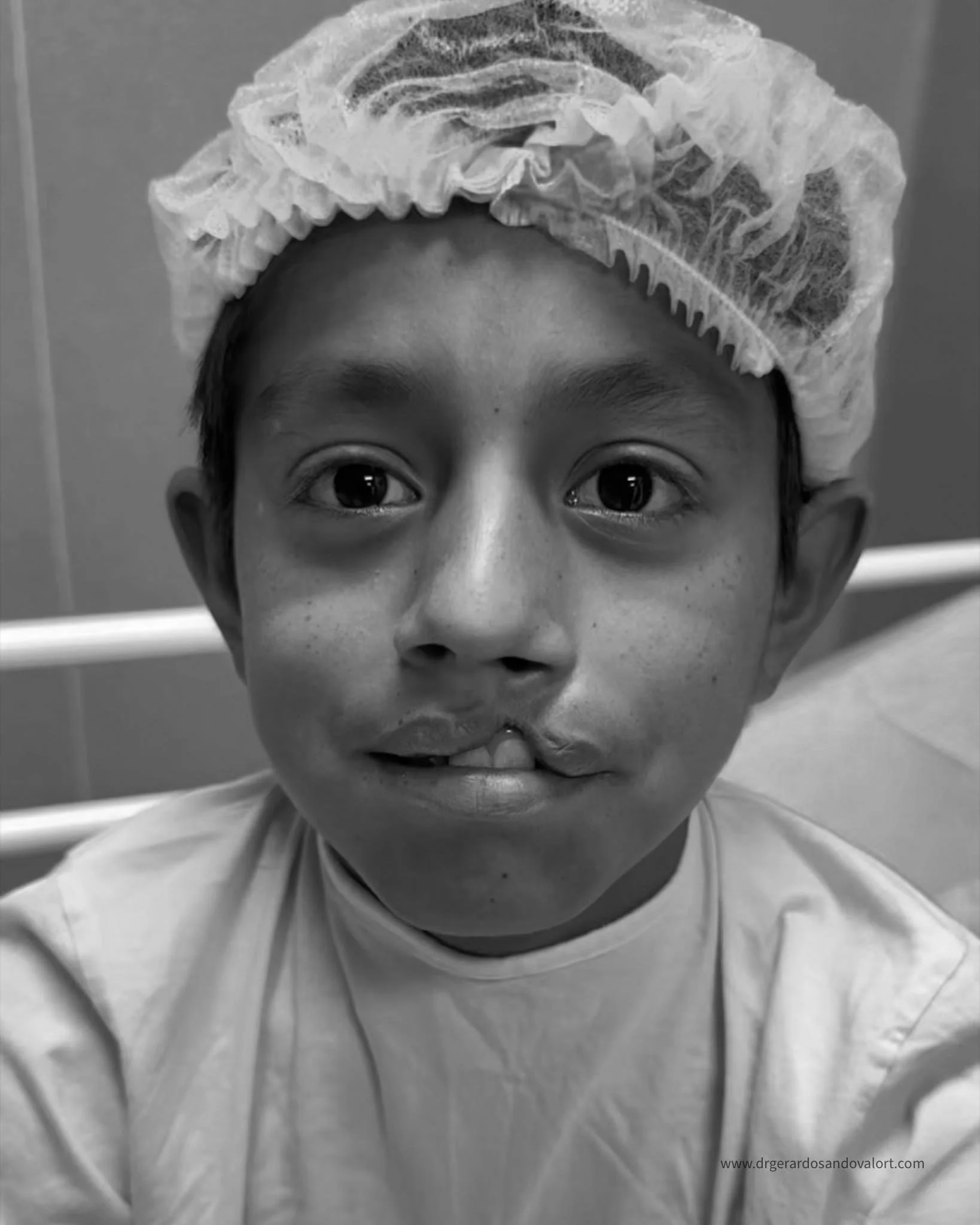 Primer plano de un paciente pediátrico con labio fisurado antes de su cirugía reconstructiva con el Dr Luis Gerardo Sandoval