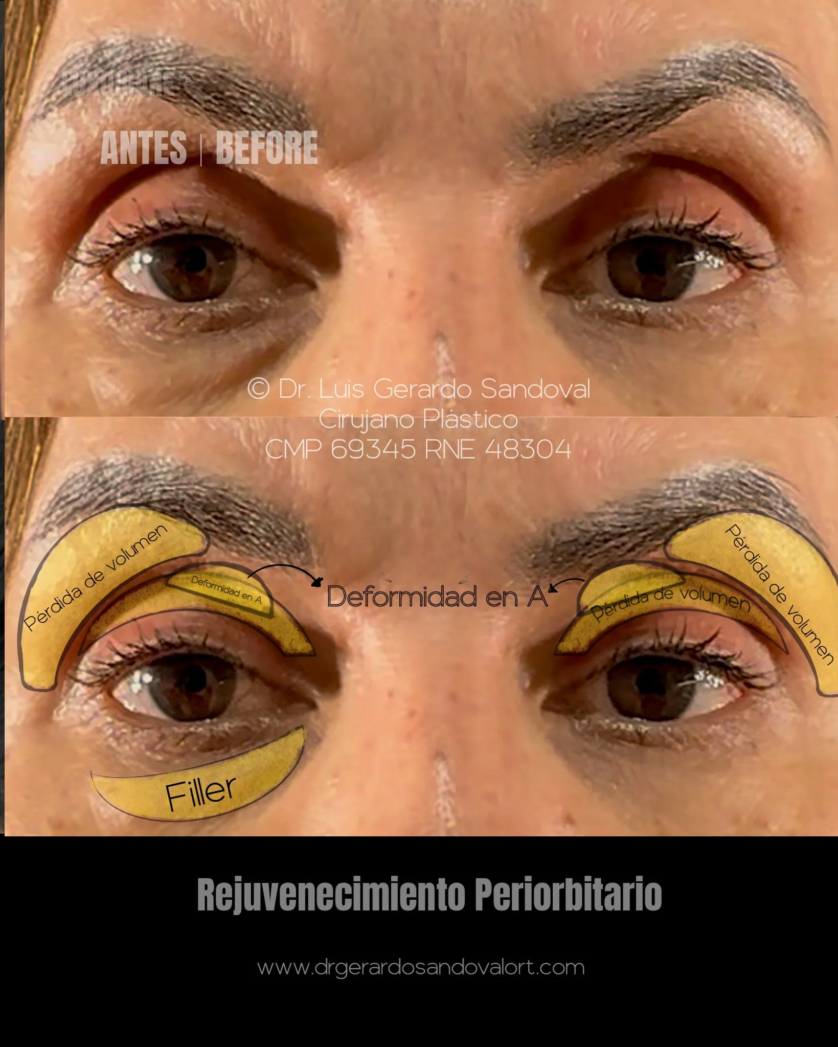 Antes del rejuvenecimiento periorbitario con blefaroplastia transcutánea y lipofilling: pérdida de volumen en párpado superior, deformidad en A y restos de filler infraorbitario, evaluado por el Dr. Luis Gerardo Sandoval, cirujano plástico en Lima.