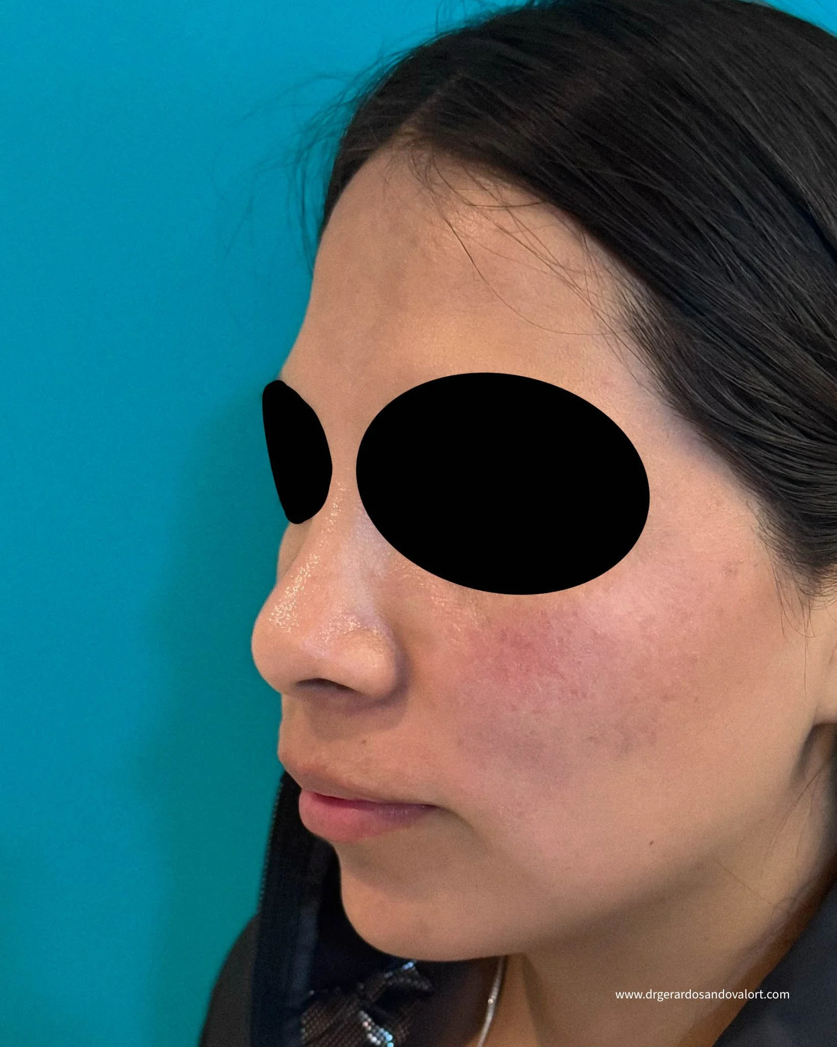 Foto de perfil a 45 grados para consulta virtual de rinoplastia, mostrando la nariz y rostro desde ambos lados para evaluación precisa