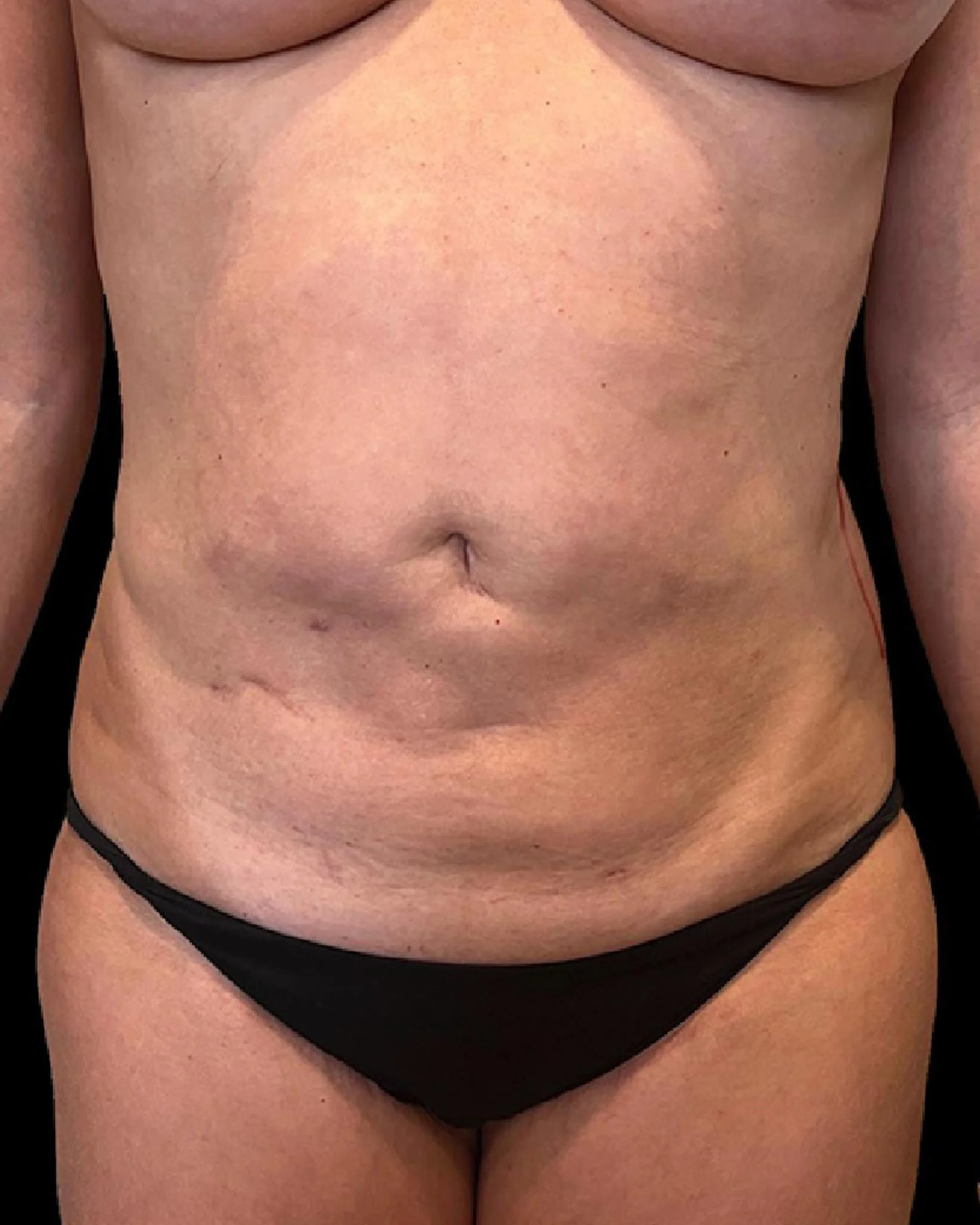 Paciente con irregularidades abdominales después de una liposucción primaria, mostrando la importancia de las tecnologías avanzadas como VASER® para corregir problemas estéticos.