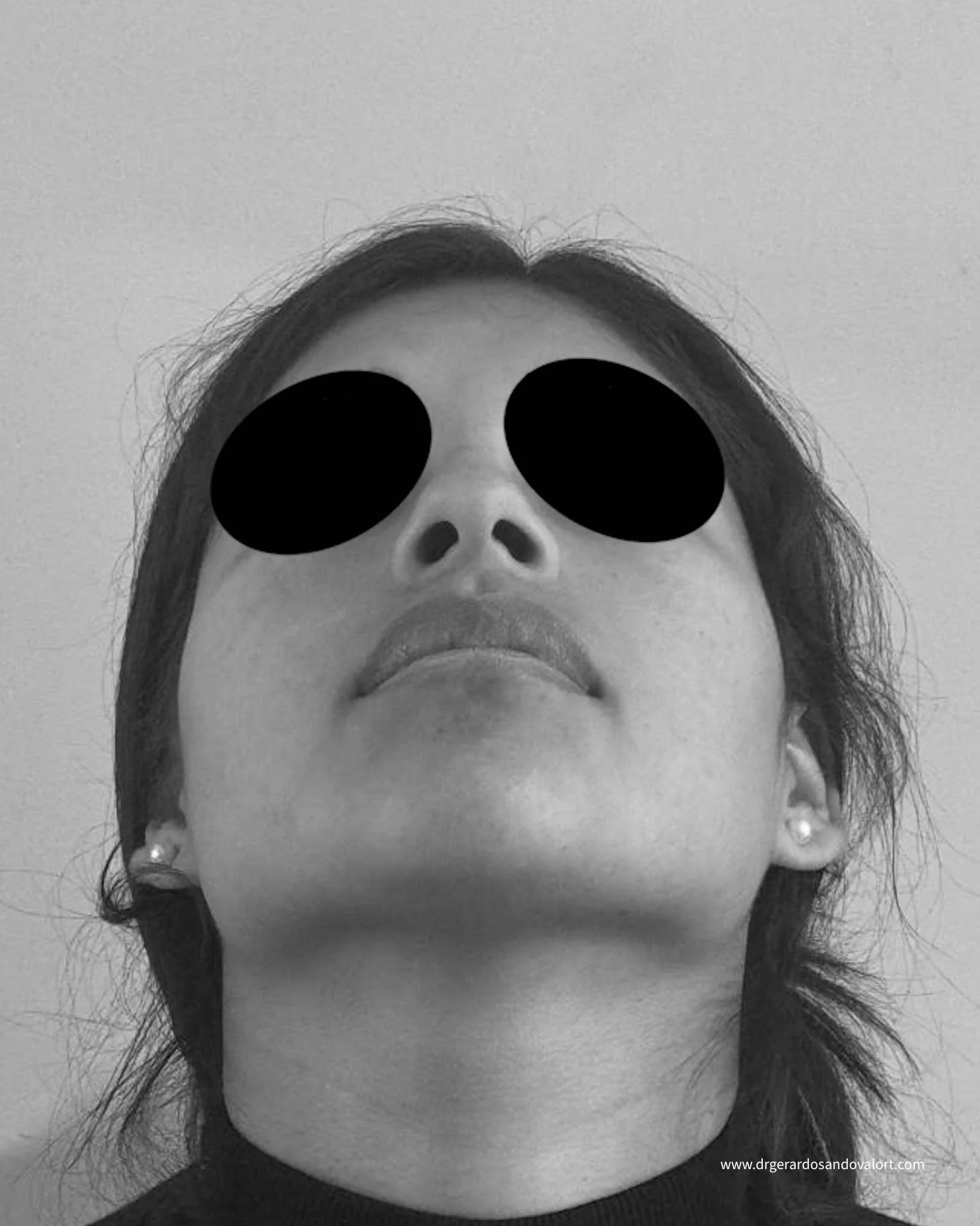 Imagen desde la base de la nariz para análisis en consulta virtual de rinoplastia, esencial para examinar la forma y simetría