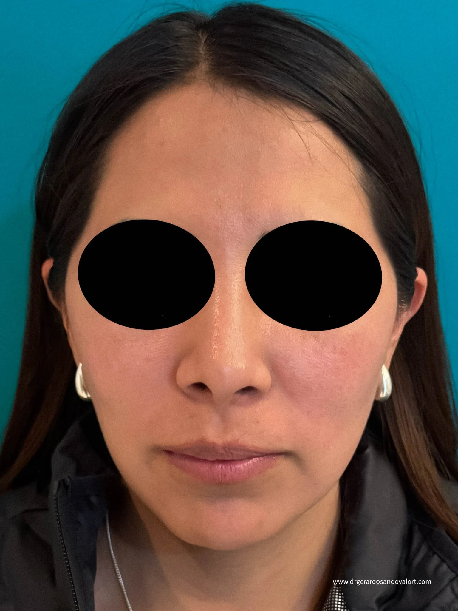 Foto frontal para consulta virtual de rinoplastia con el Dr. Luis Gerardo Sandoval, para evaluación detallada de la nariz y perfil facial