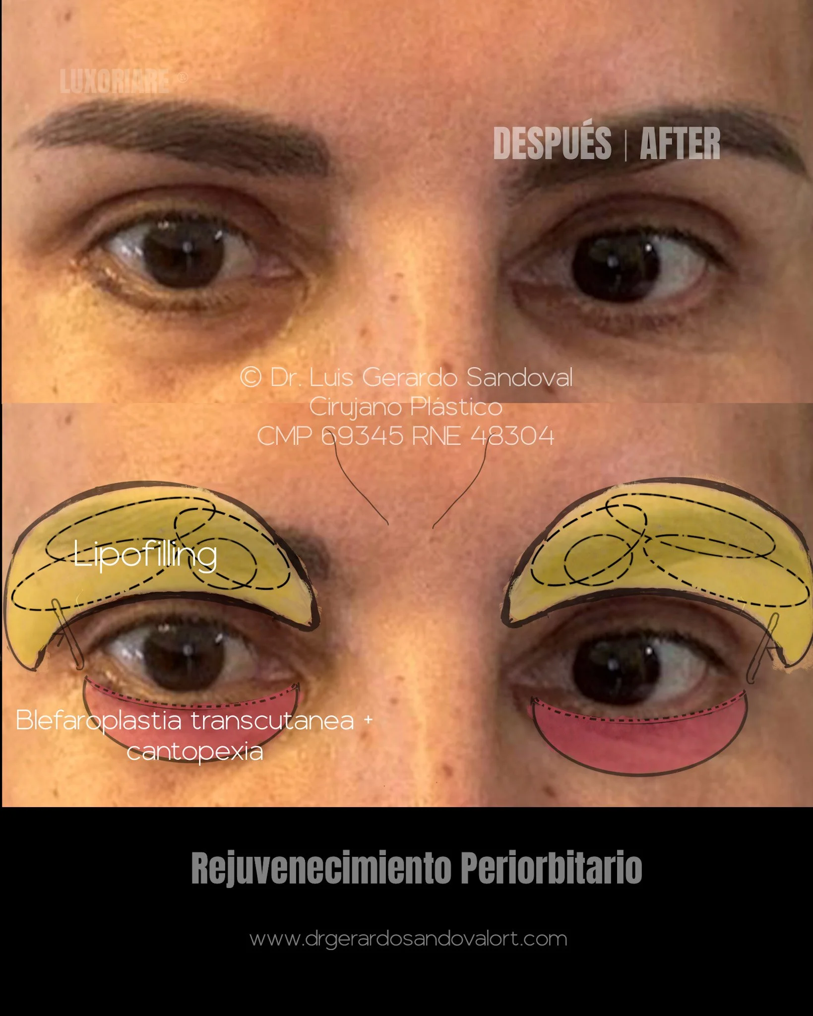Caso real después de rejuvenecimiento periorbitario en Lima: blefaroplastia, cantopexia y lipofilling con resultado natural y armónico.