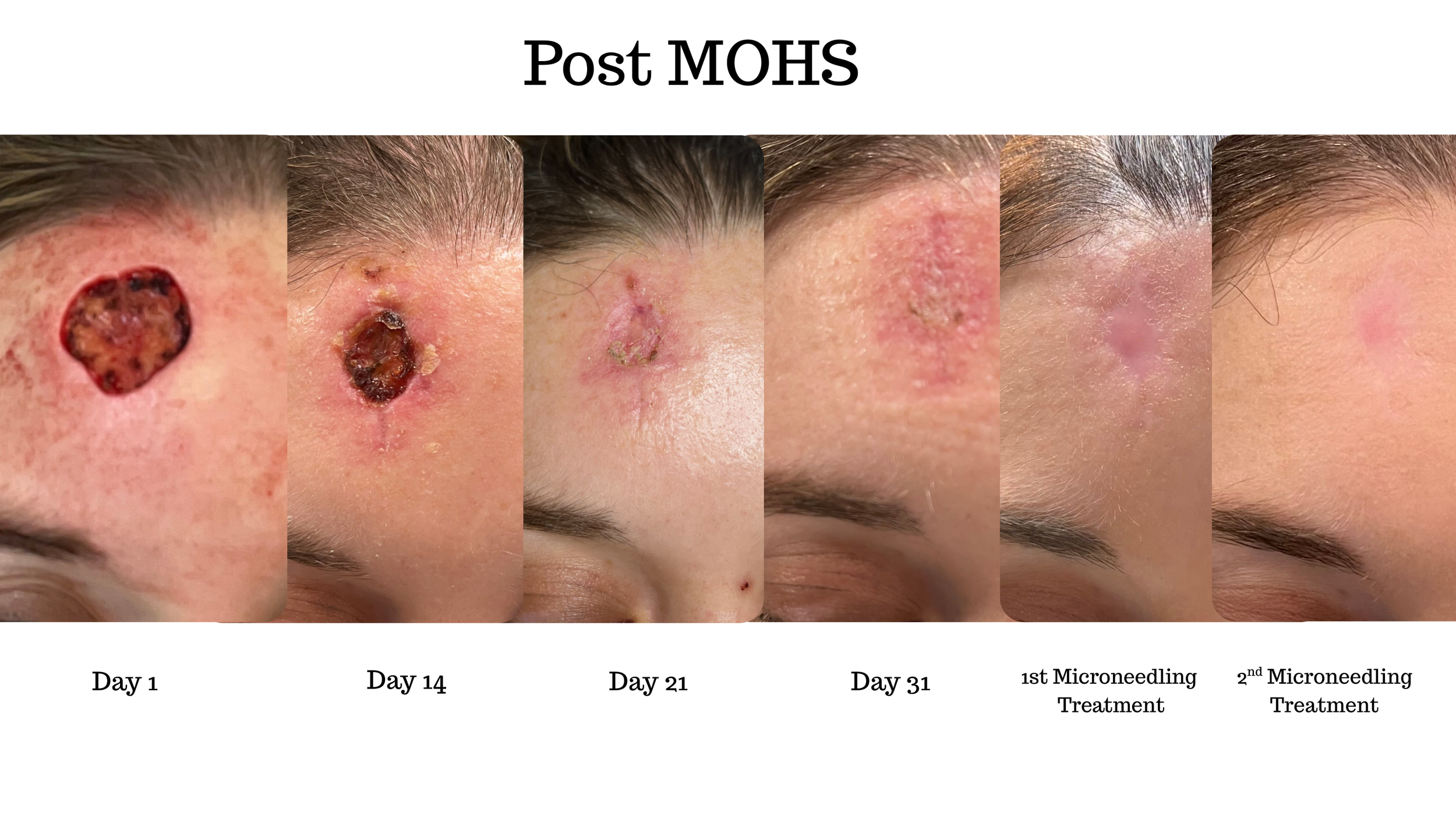 Healing process using ReyaGel (an MPT Technology) of a skin wound on the forehead over 31 days, showing progressive healing from an open sore to a closed, healed scar.
