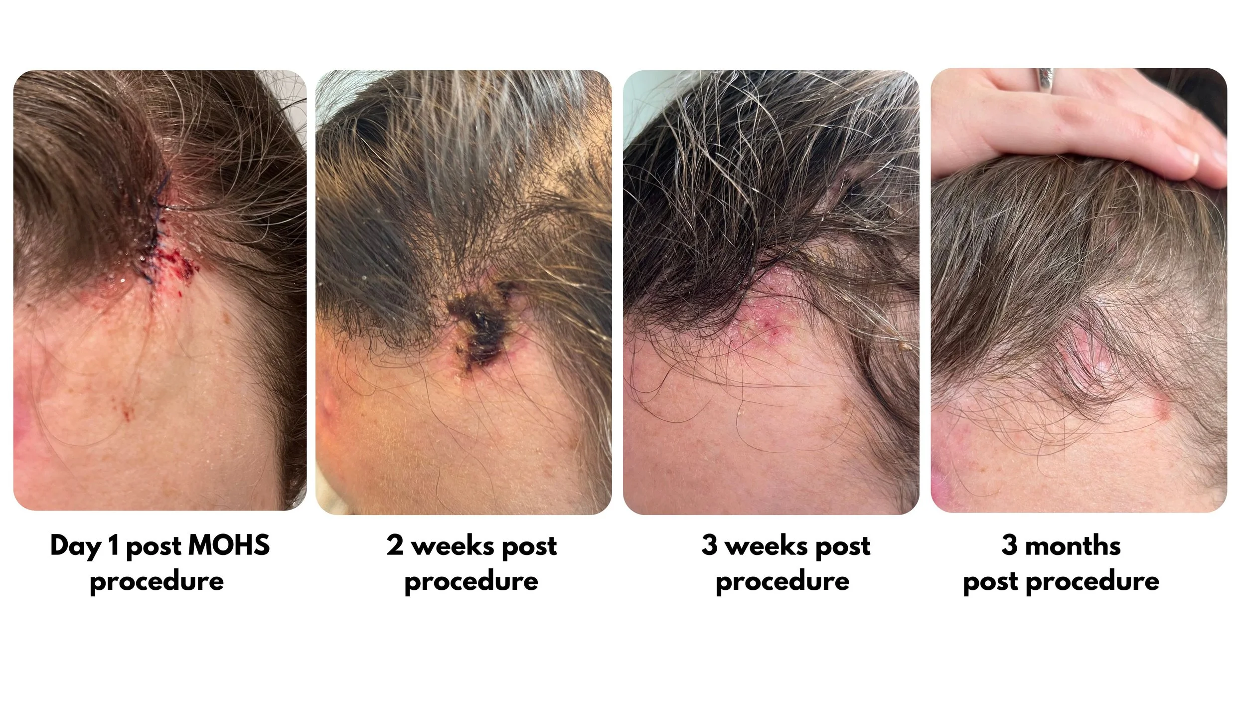 Healing process using ReyaGel (an MPT Technology) of a skin wound on the forehead over 31 days, showing progressive healing from an open sore to a closed, healed scar.
