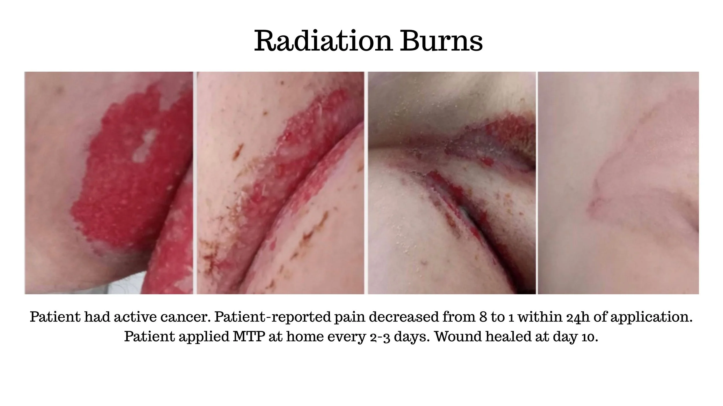 Healing process using ReyaGel (an MPT Technology) of a skin wound on the forehead over 31 days, showing progressive healing from an open sore to a closed, healed scar.