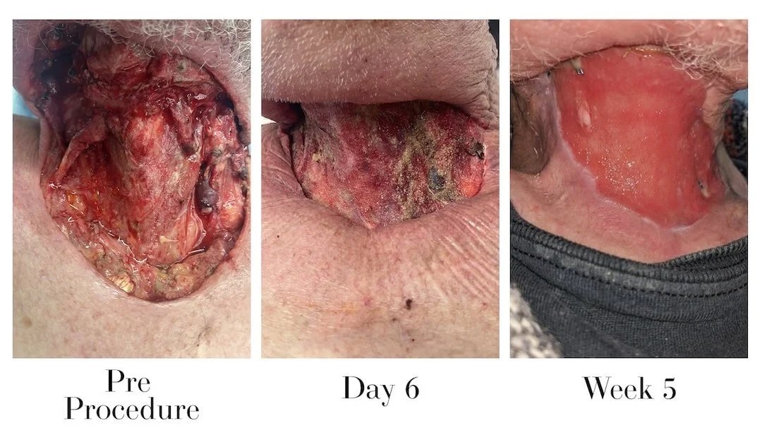 B&A_necrotize_2-min (1).jpeg