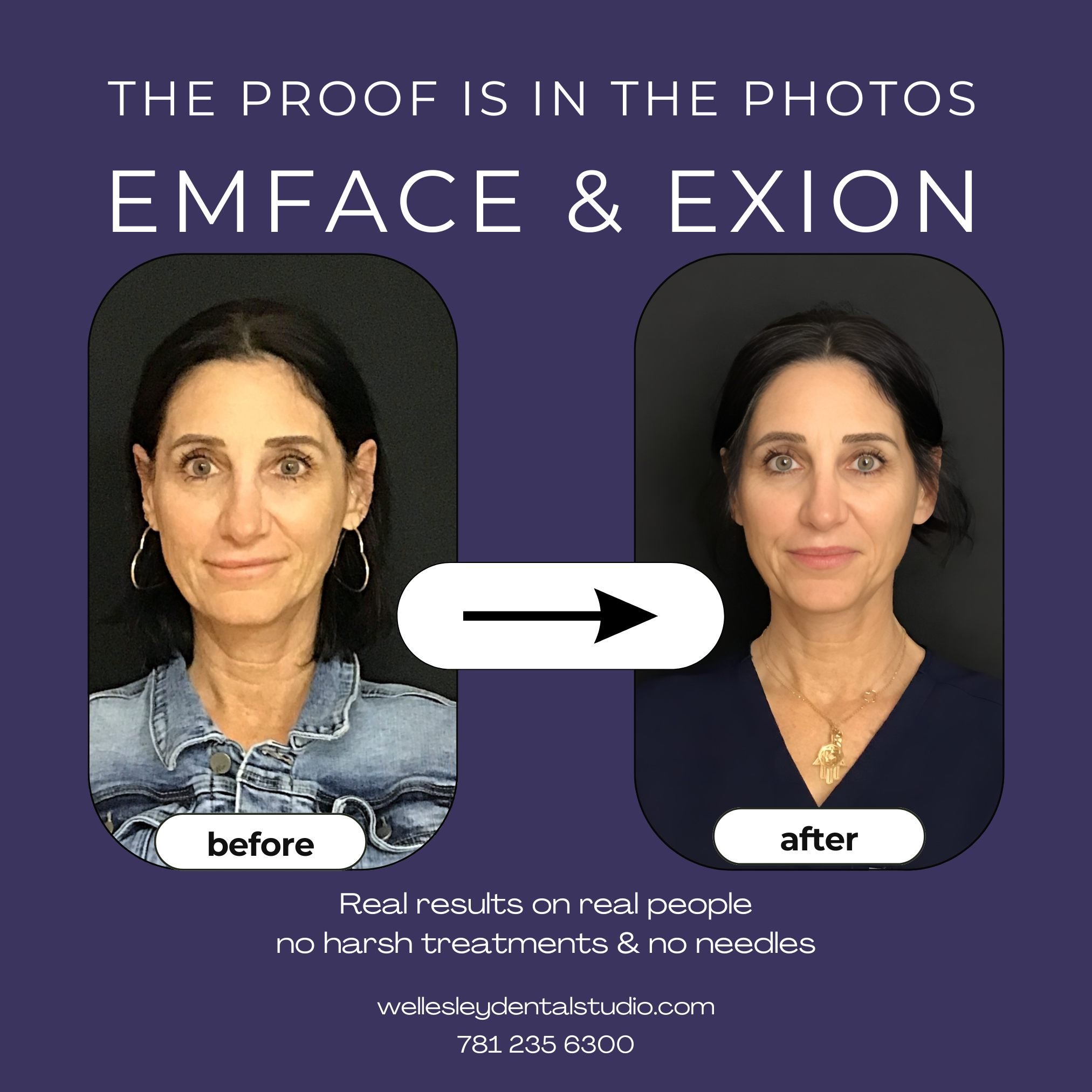 When the look you want is undetectably natural, we know just how to help! Wellesley Dental Studio and @btlaesthetics can deliver what you remember. #GlowUp #dentistknowsbest #aboutface #NaturalBeauty #lovingthelook #btlbeauty