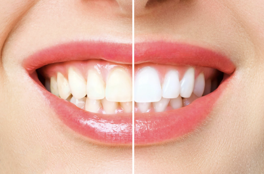 Professional Teeth Whitening vs. Store-Bought Kits: What Dentists Recommend