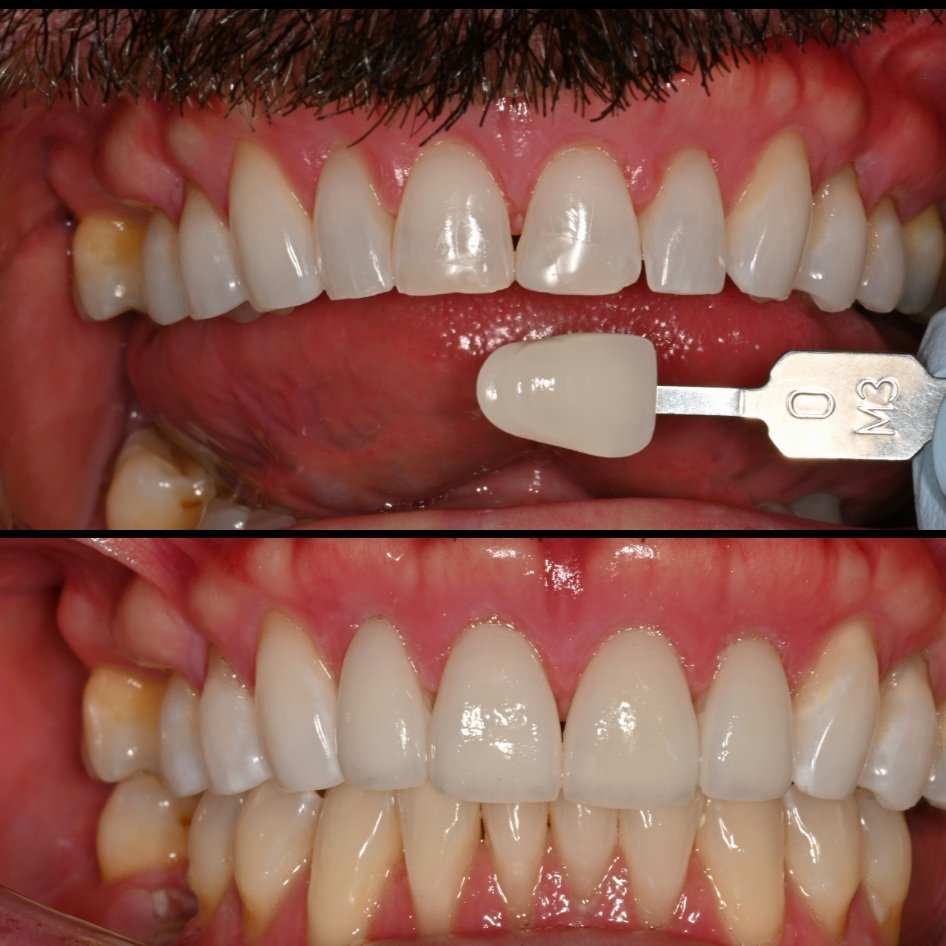 Before &amp; After | Veneers