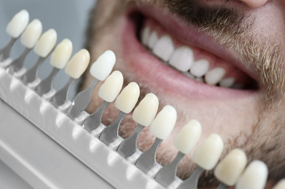 Teeth Whitening vs. Veneers: Which Cosmetic Dental Treatment Is Right for You?
