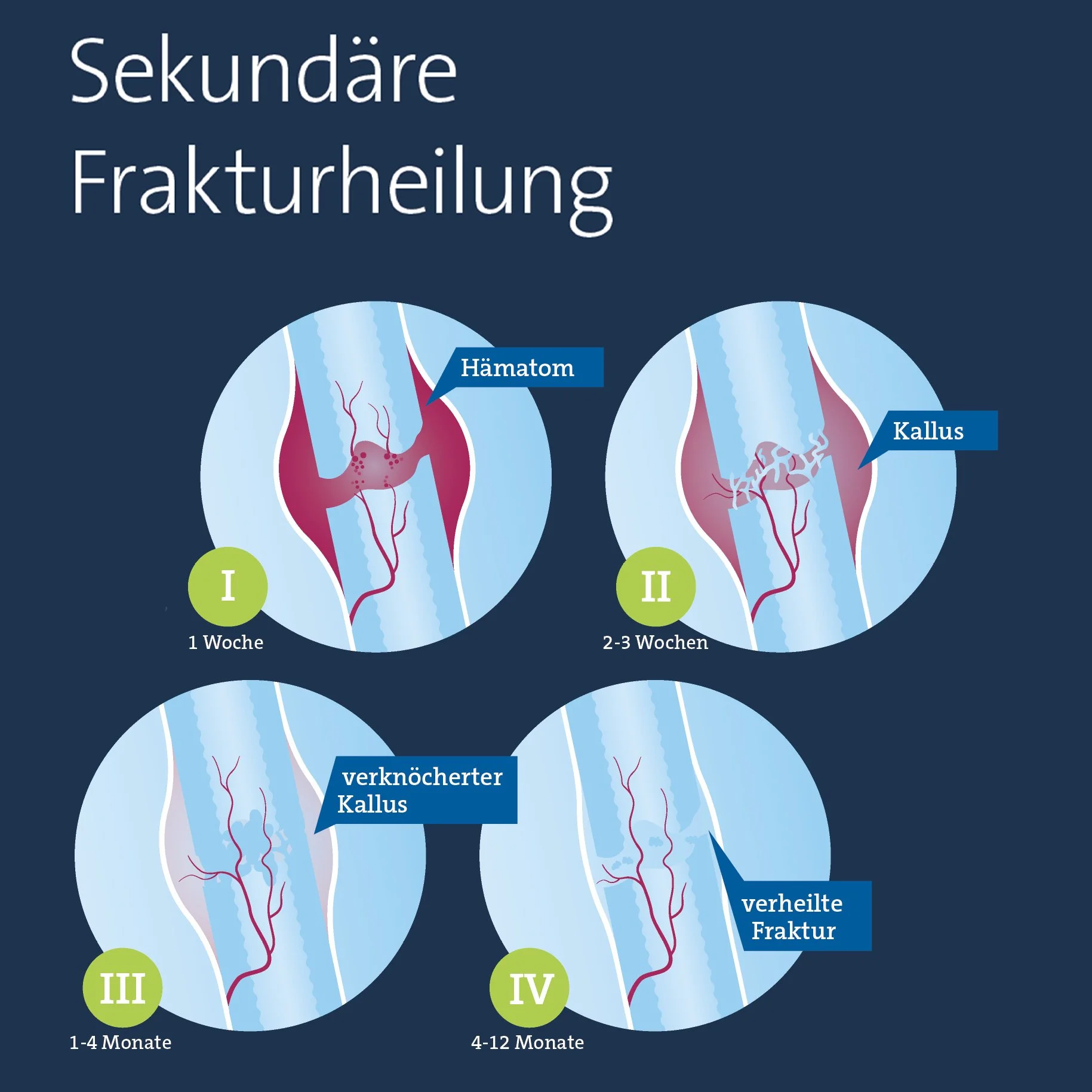 Medizinische Infografik der vier Phasen sekundärer Frakturheilung: Hämatom, Kallus, verknöcherter Kallus und verheilte Fraktur