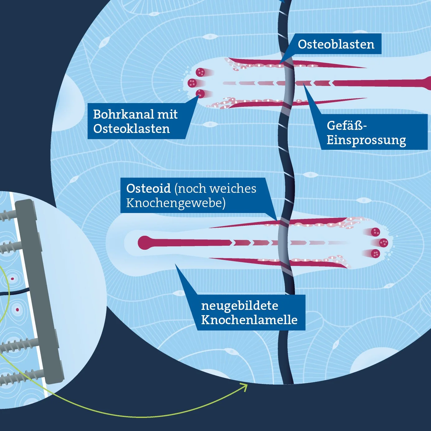 Medizinische Infografik der primären Frakturheilung mit Osteoblasten, Bohrkanal mit Osteoklasten, Gefäß-Einsprossung, Osteoid und neugebildeter Knochenlamelle bei Plattenfixierung