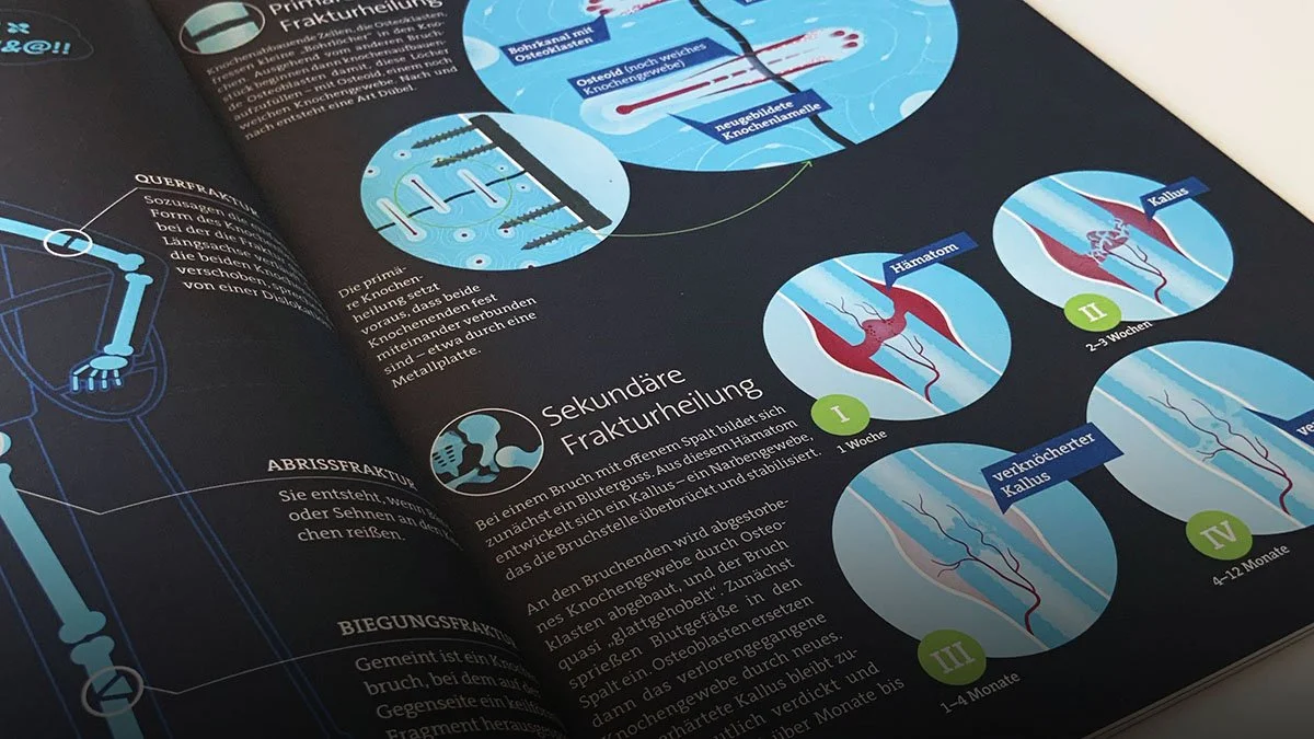 Abbildung der Infografiken zum Thema Knochenbrüche im Magazin PulsM