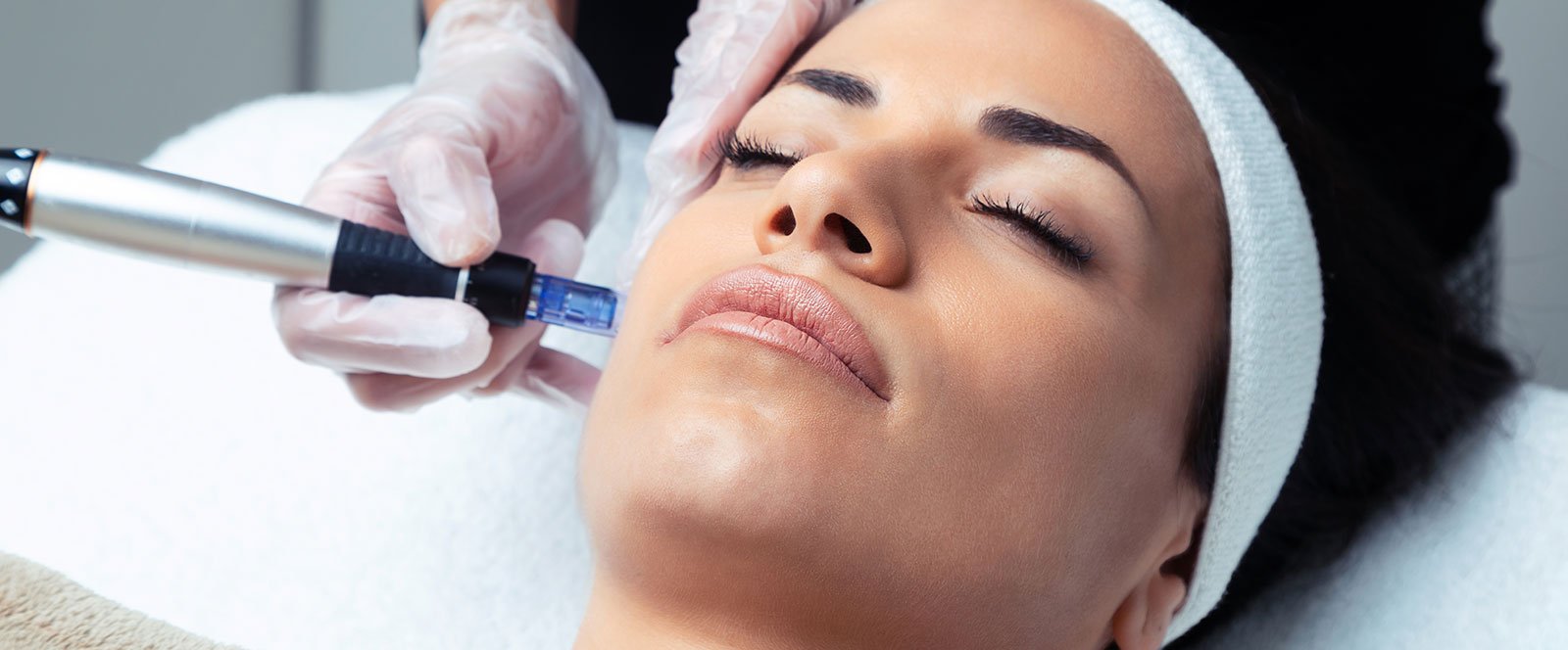 What is Microneedling?
