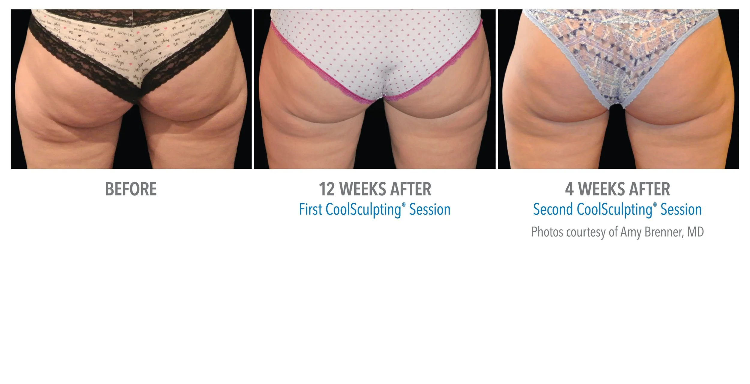 Comparison of women's buttocks before and after CoolSculpting sessions, showing improvement in skin appearance. The first image labeled 'BEFORE' shows skin with cellulite. The middle image, '12 WEEKS AFTER', shows smoother skin after the first session. The third image, '4 WEEKS AFTER', shows further improvement after the second session. Text indicates the images are courtesy of Dr. Amy Brenner.