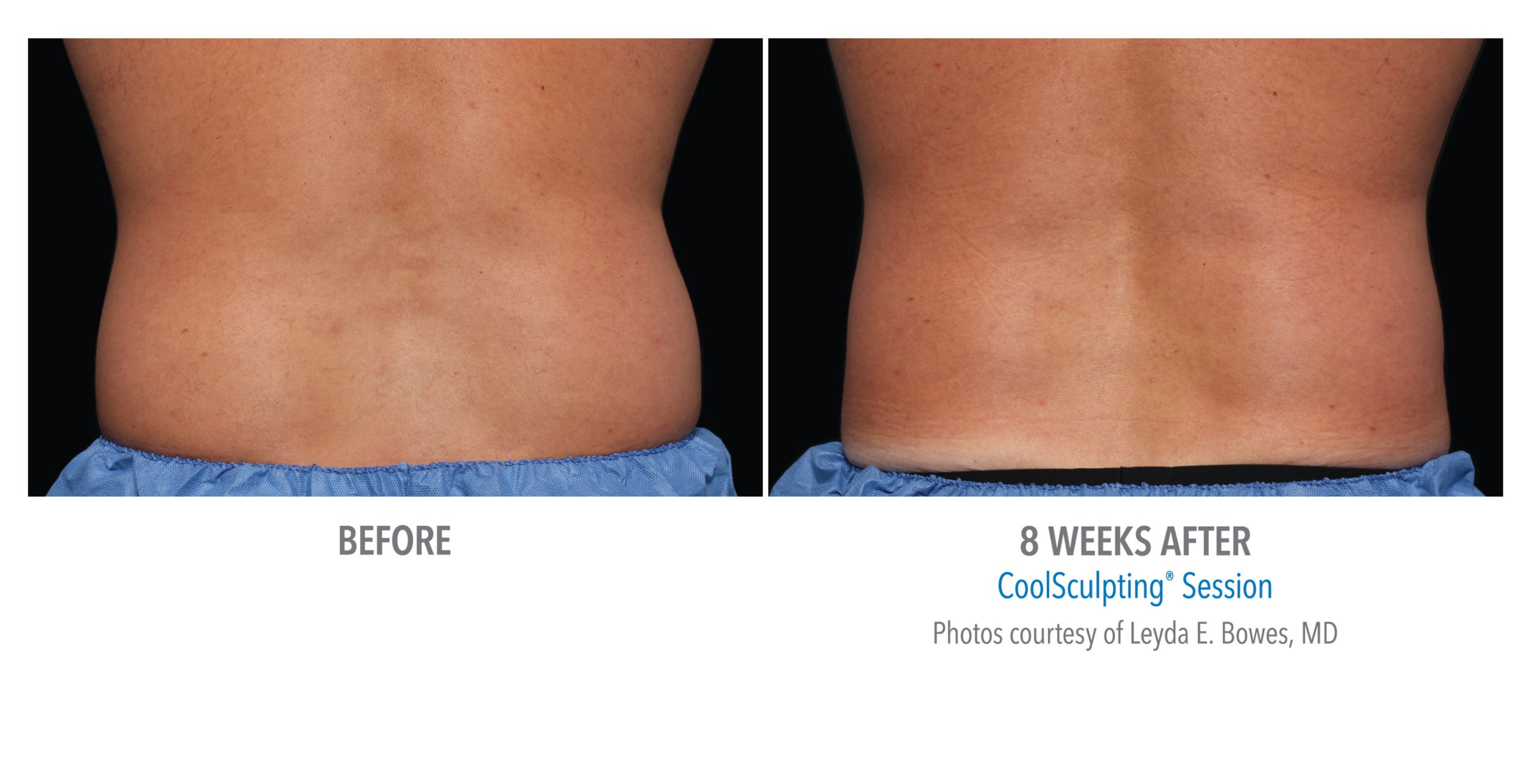 Comparison of a person’s lower back before and 8 weeks after a CoolSculpting session, showing reduction in fat