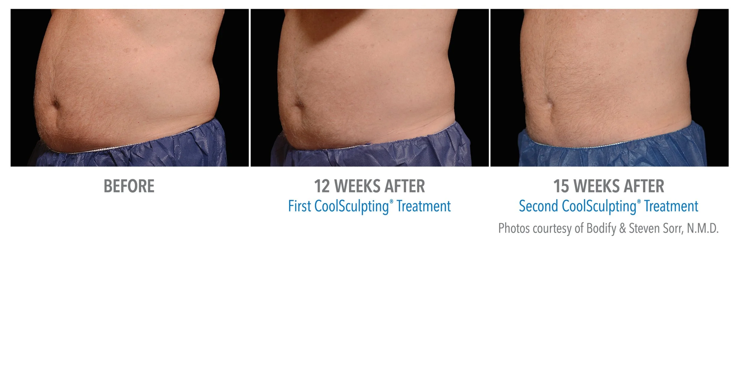 Sequence of three photos showing the side of a person's abdomen before and after CoolSculpting treatments, with the first photo labeled as 'Before,' the second at 12 weeks after the first treatment, and the third at 15 weeks after the second treatment, demonstrating reduction in abdominal fat.