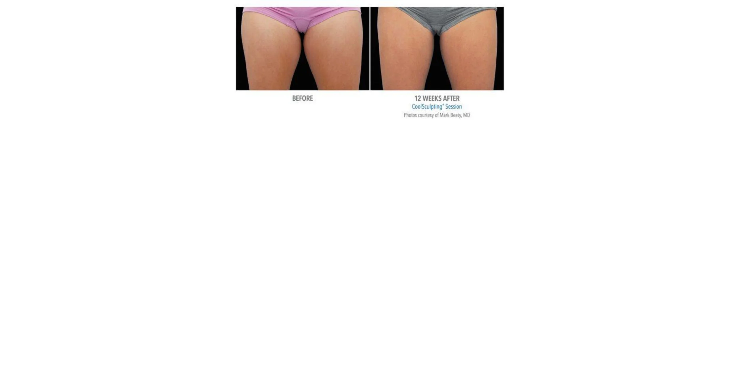 Comparison of thighs before and after 12 weeks of CoolSculpting, showing reduced fat and smoother skin in the after photo.