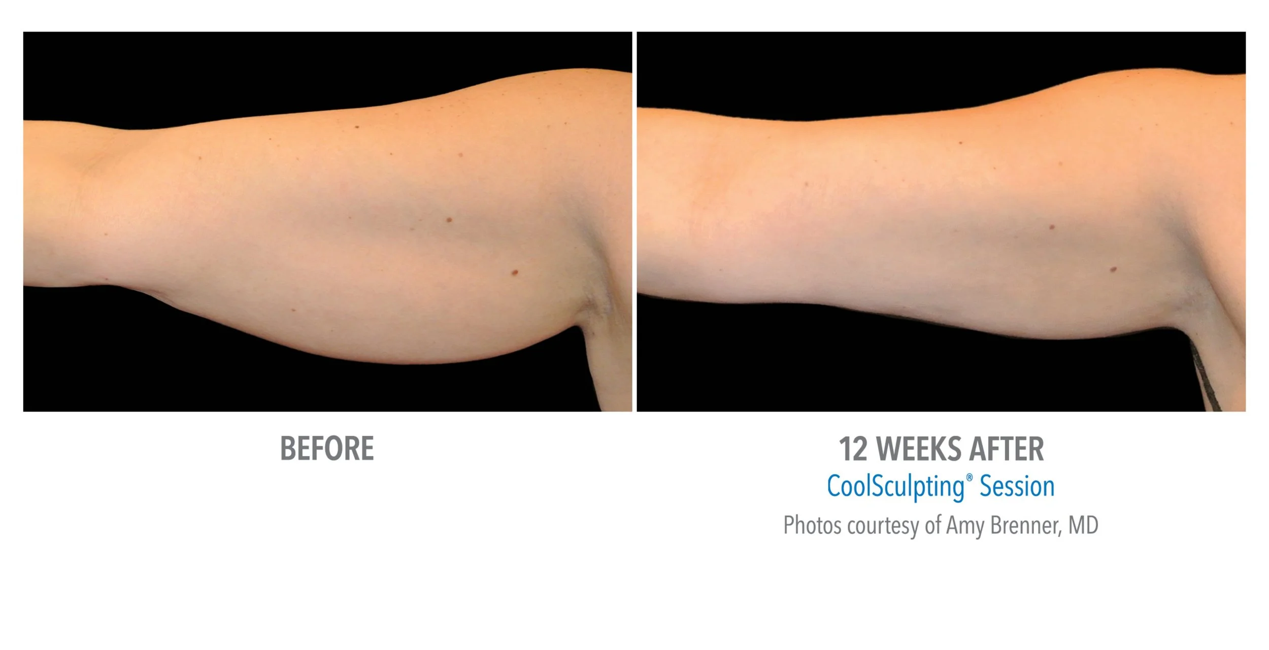 Side view of a person's upper arm and shoulder showing before and after results of a CoolSculpting session, with the area appearing slimmer after 12 weeks.