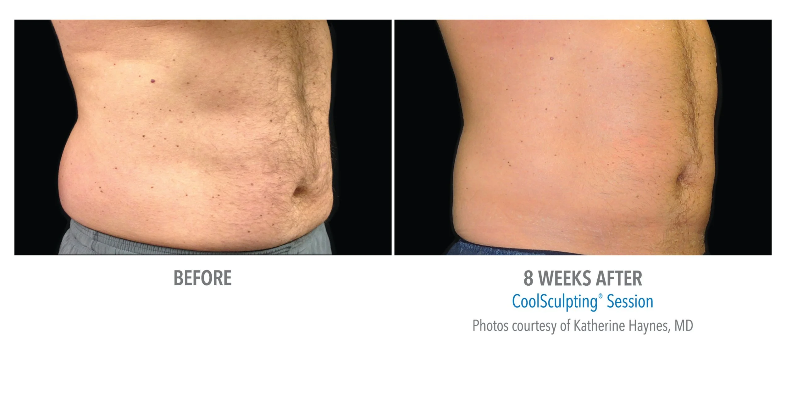 Comparison of a man's abdominal area before and 8 weeks after a CoolSculpting session, showing reduced fat and a flatter stomach.