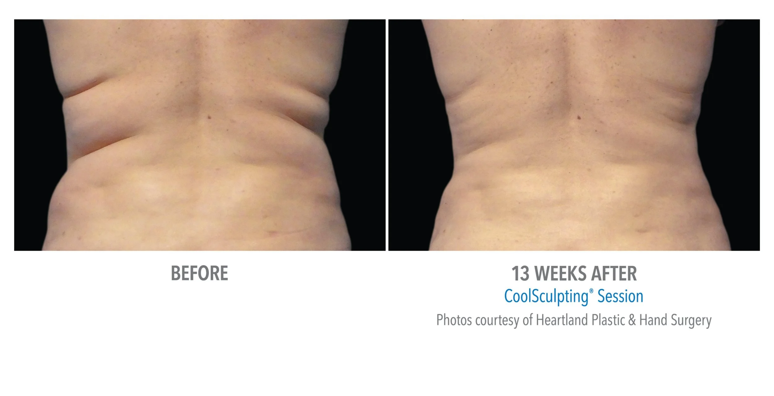 Comparison image showing the back of a person before and 13 weeks after a CoolSculpting session, highlighting reduction of back fat.