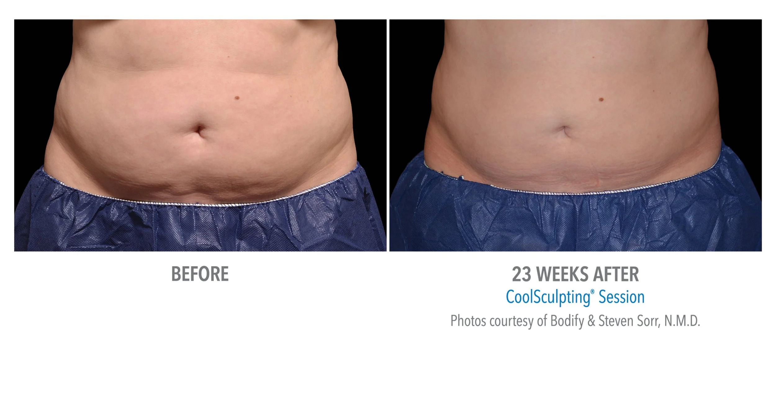 Side-by-side comparison of a person's abdomen before and after 23 weeks of CoolSculpting, showing reduced abdominal fat and a smoother appearance.