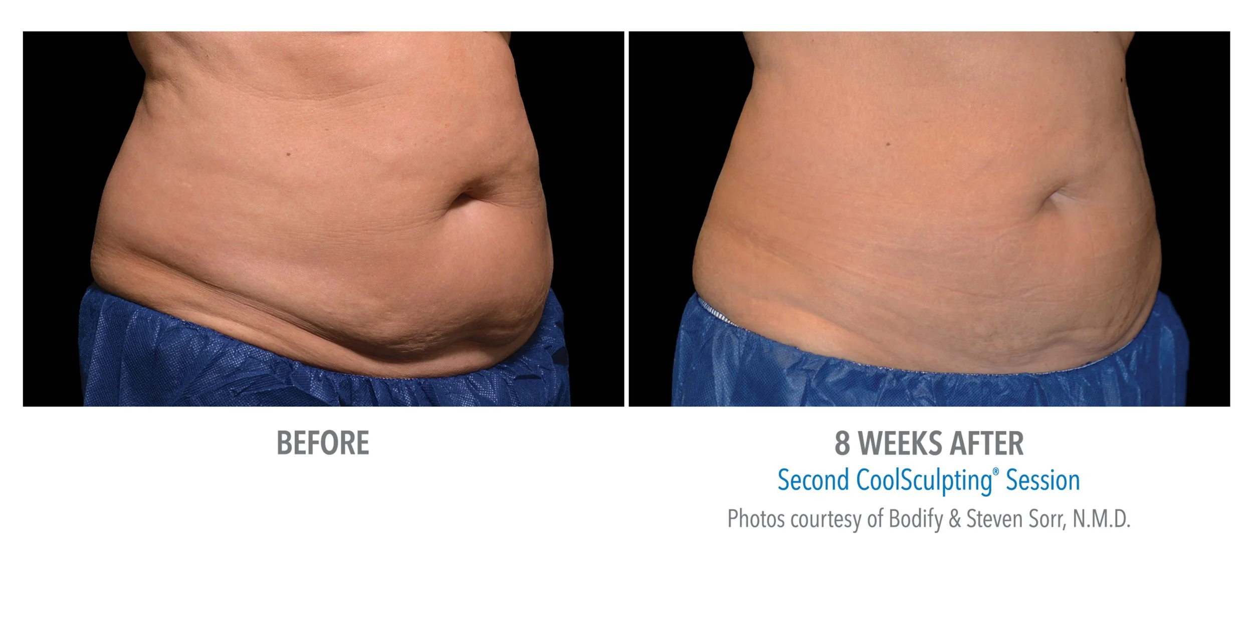 Comparison of abdomen before and 8 weeks after second CoolSculpting session showing reduction in fat and improved contour.