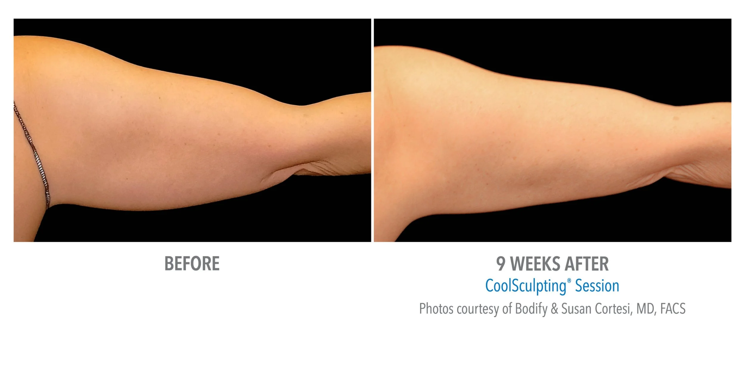 Side-by-side comparison of an arm before and after a CoolSculpting session, showing visible reduction in arm fat over nine weeks.