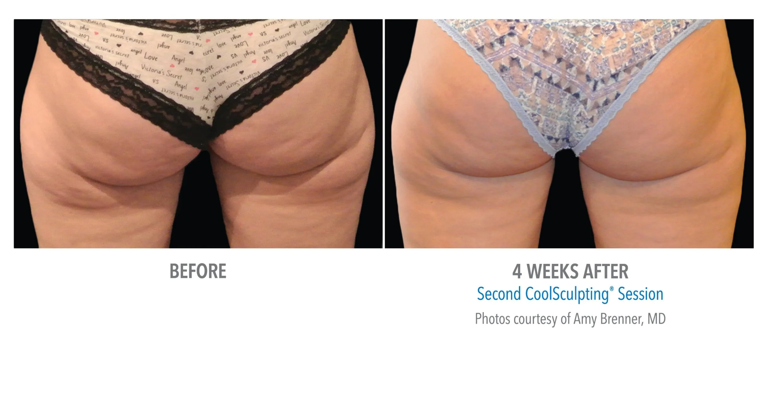 Comparison of the same person’s buttocks before and four weeks after a second CoolSculpting session, showing reduced cellulite and improved contour, with the person wearing different patterned underwear in each photo.