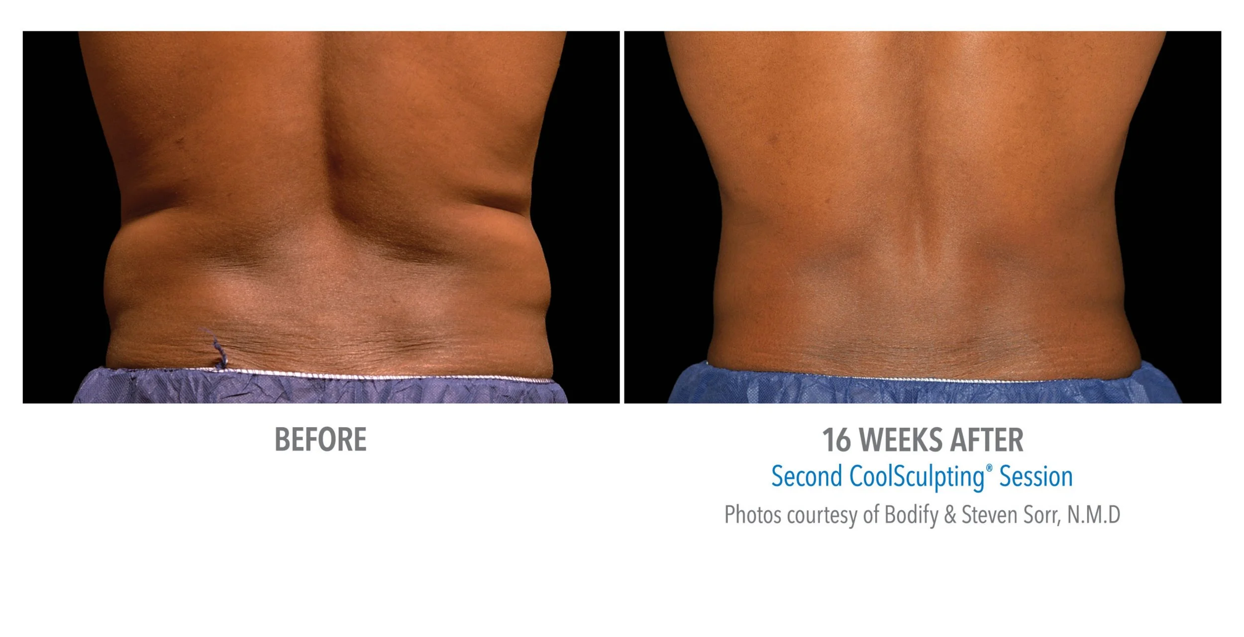 Side-by-side comparison of a person's back before and after 16 weeks of CoolSculpting treatment, showing reduced fat and improved body contour.