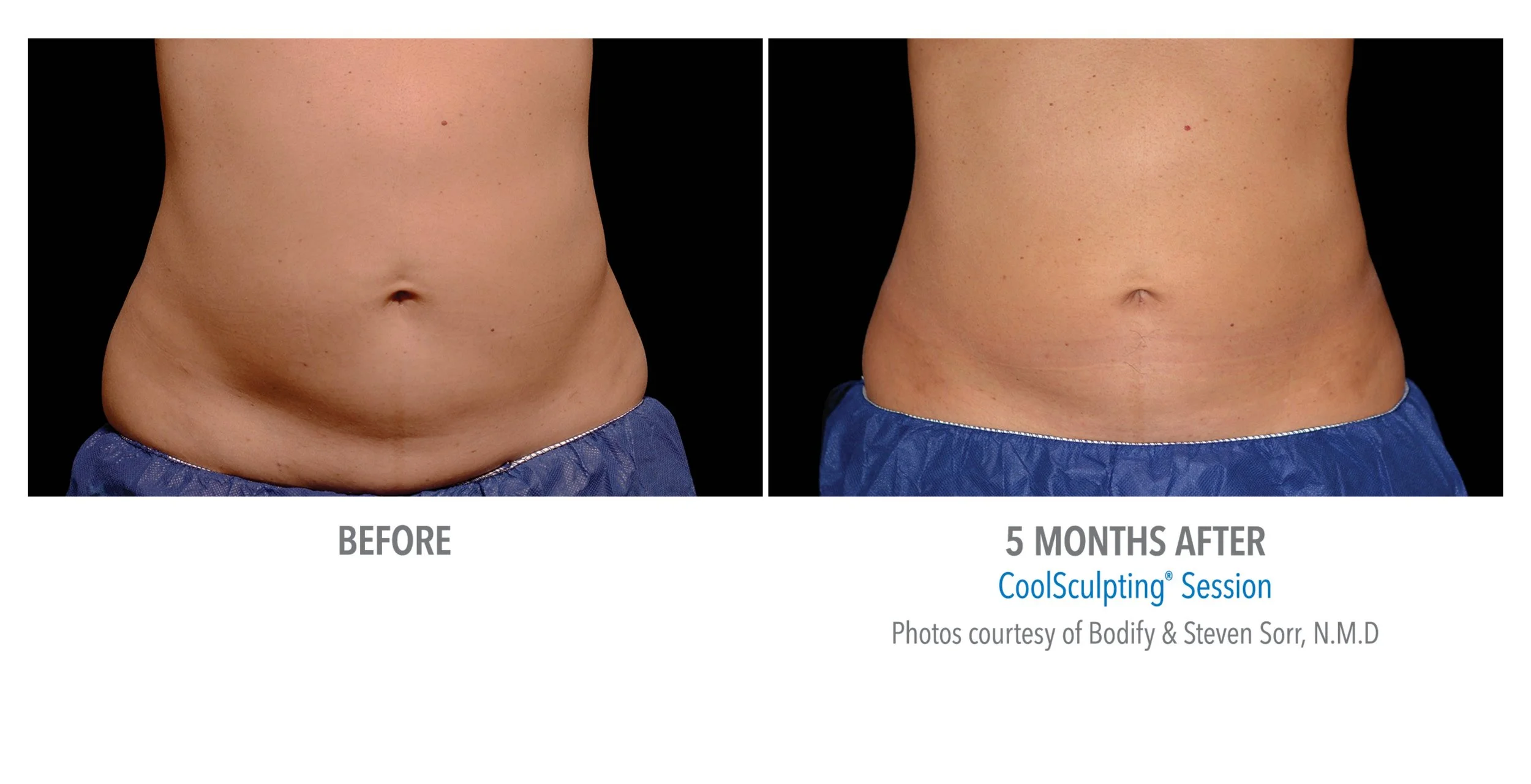 Side-by-side comparison of a person's abdomen before and 5 months after a CoolSculpting session, showing reduced fat and a flatter stomach.
