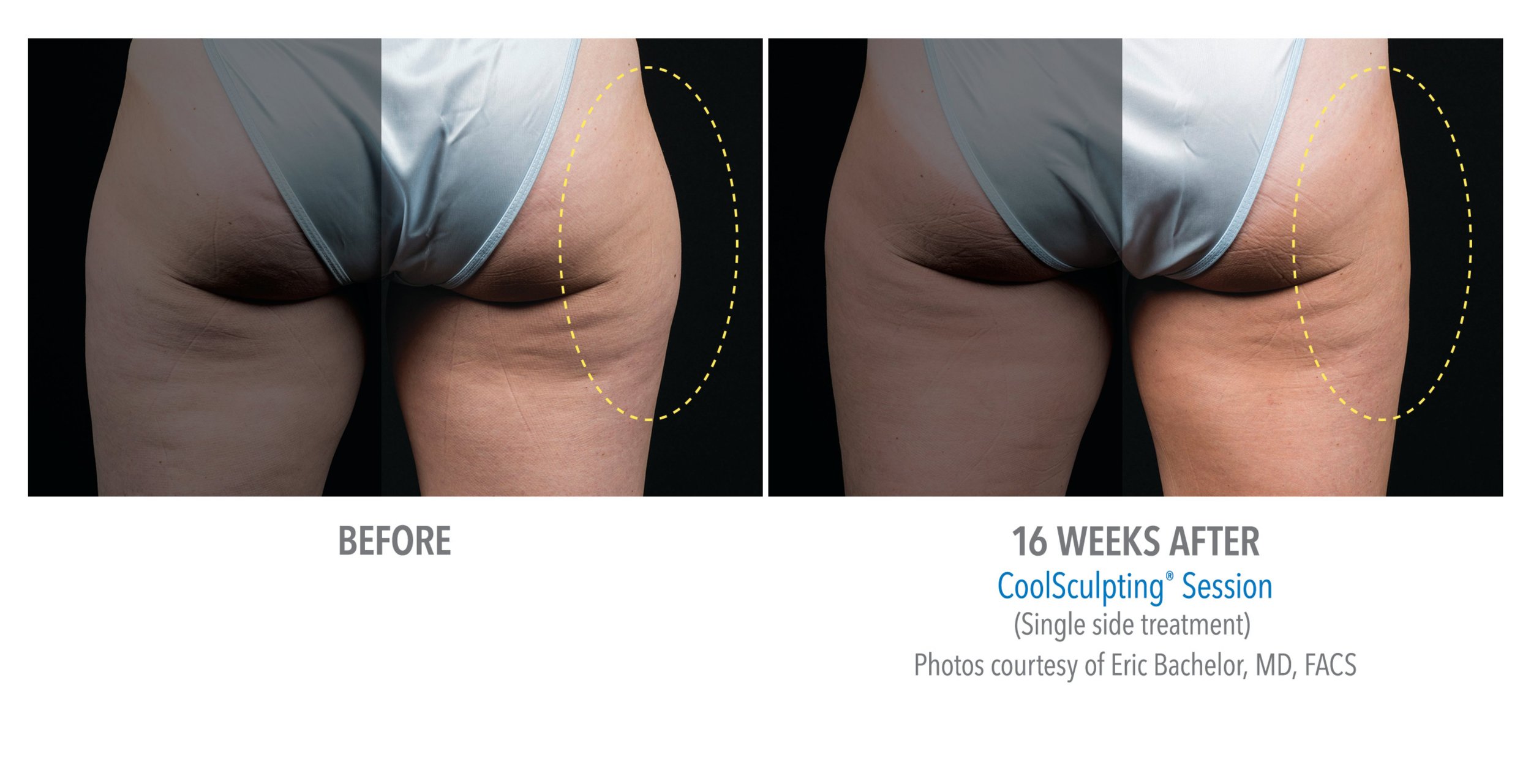 Side-by-side comparison of a woman's lower back and buttocks before and after 16 weeks of CoolSculpting, showing reduction in fat and improved skin texture, with dotted yellow circles highlighting changes.