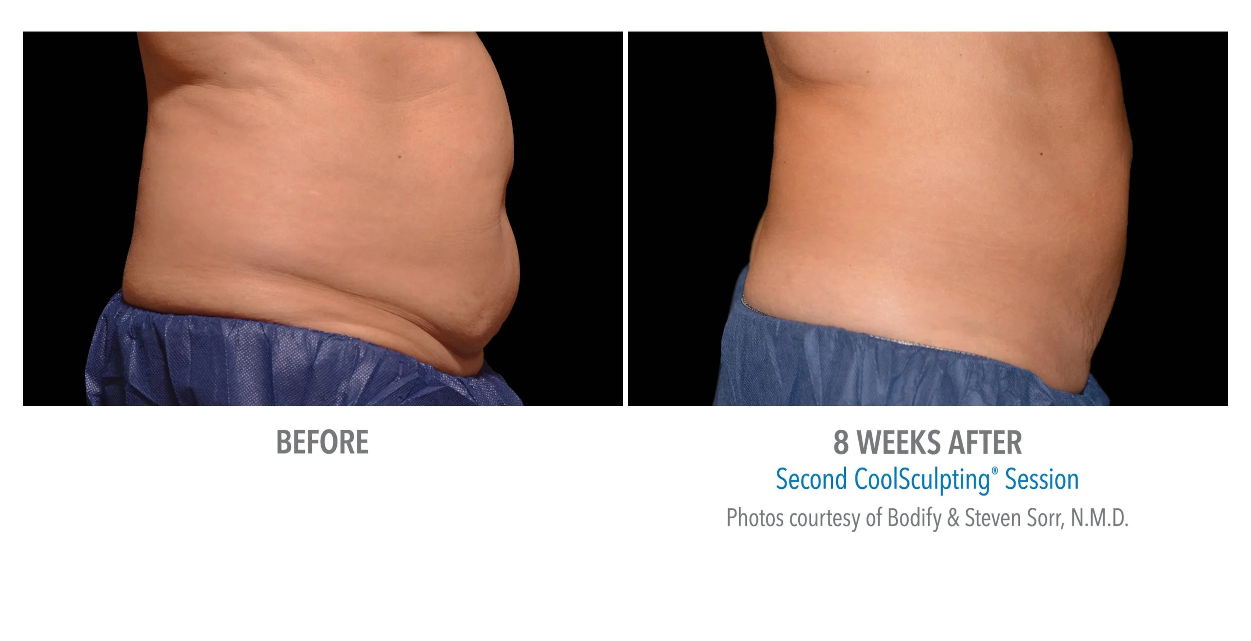 Side-by-side comparison of a person's abdomen before and 8 weeks after two CoolSculpting sessions, showing reduced fat and a slimmer appearance.
