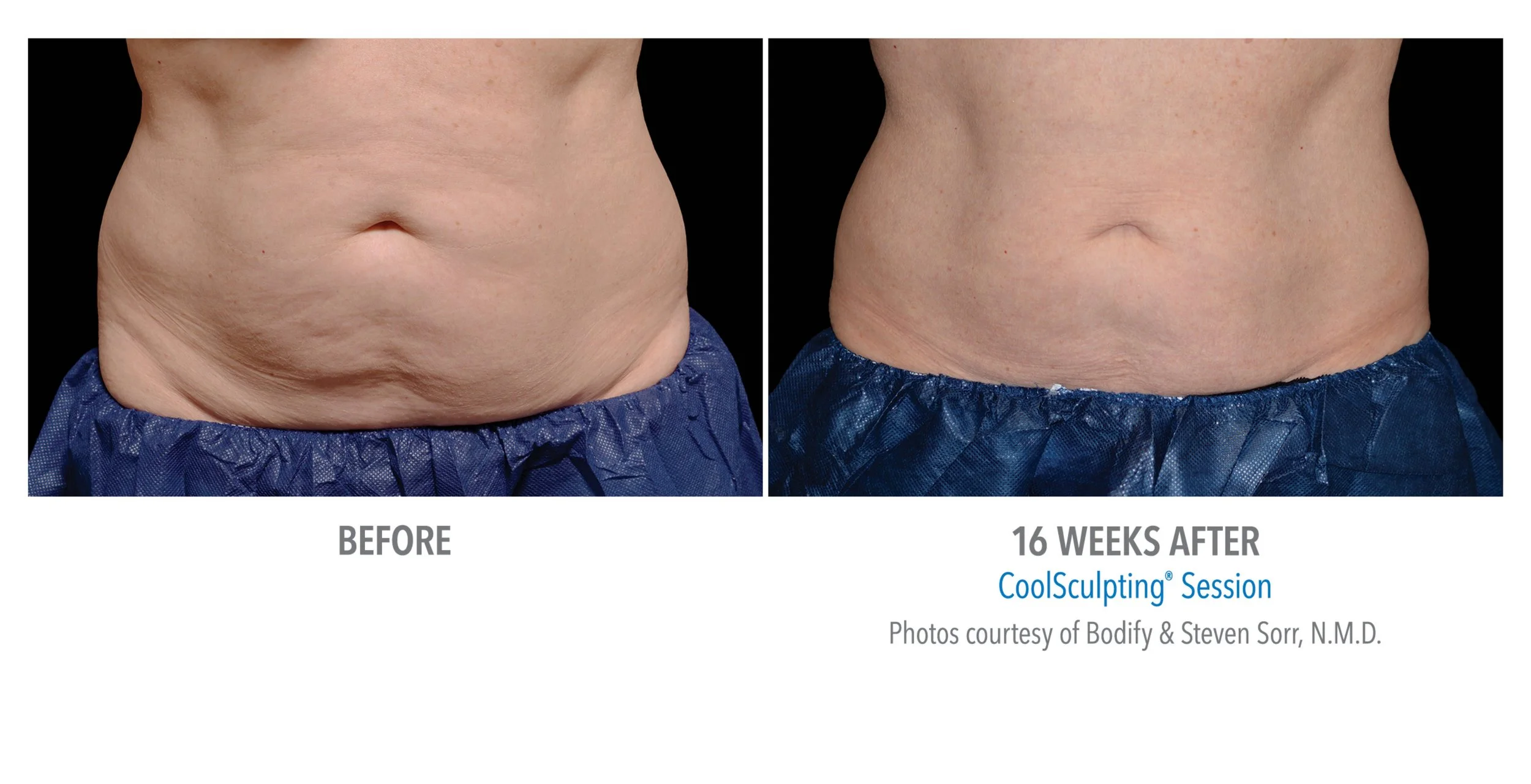 Comparison image showing a person's abdomen before and 16 weeks after a CoolSculpting session, with noticeable reduction in abdominal fat and skin tightening.